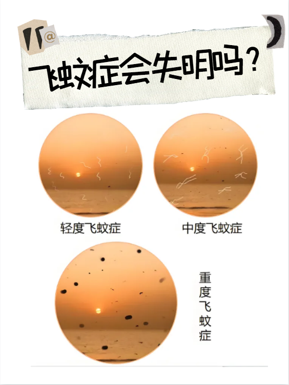 别慌!这大概率是 "飞蚊症" 找上门了!