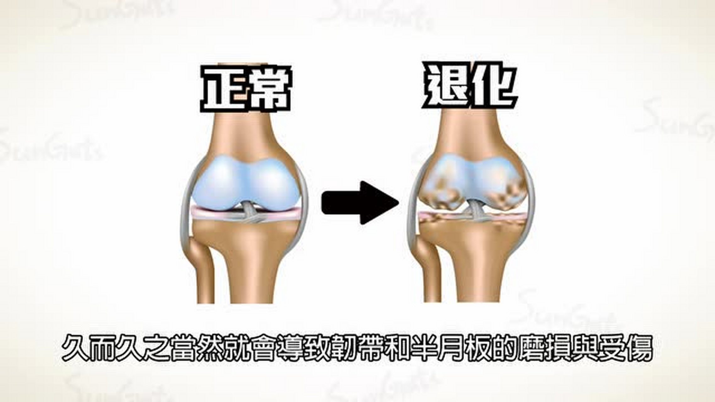 膝关节退行性病变怎么治疗  膝关节退行性病变的治疗方法主要包括保守