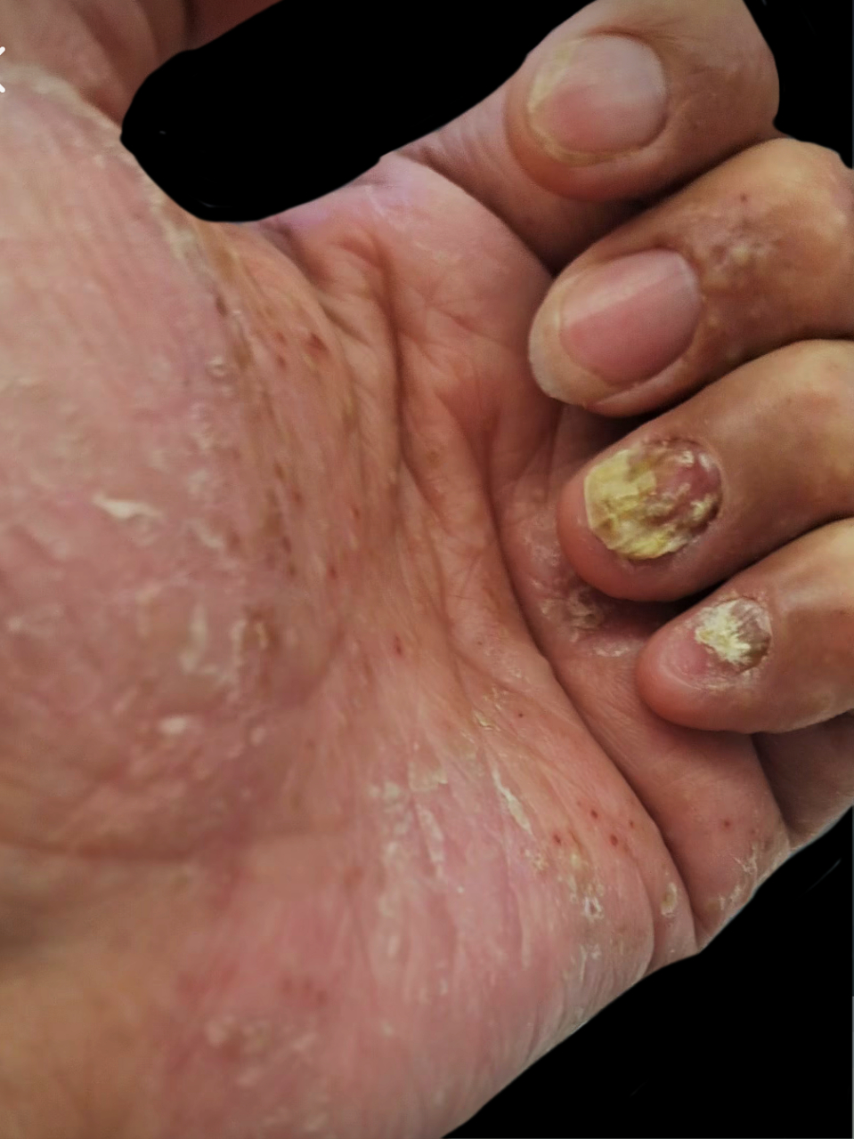 典型掌跖脓疱病,指甲和手掌受累!