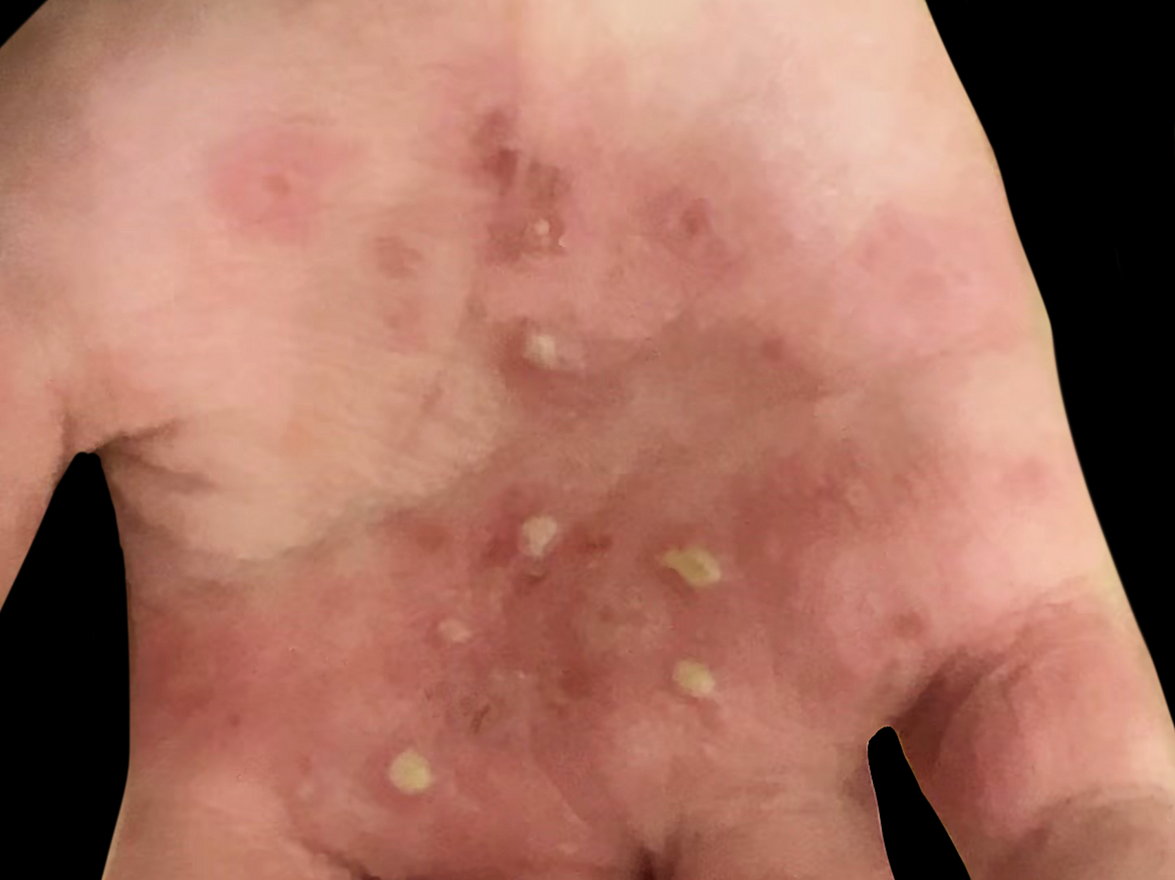 掌跖脓疱病特征之黄白色脓疱!