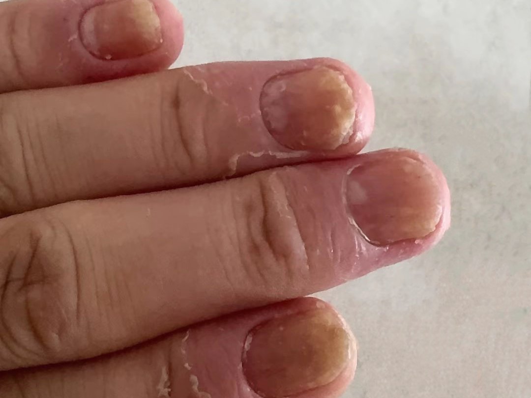 后来的关节炎发育相关,因此,指甲疾病的评估具有重要的临床重要性
