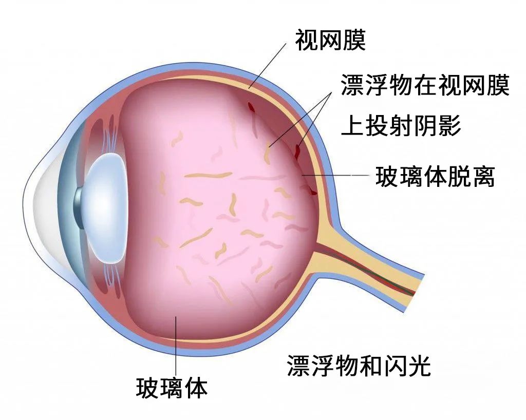 科普|玻璃体后脱离,不容小觑的眼病  玻璃体后脱离是视网膜撕裂的常见