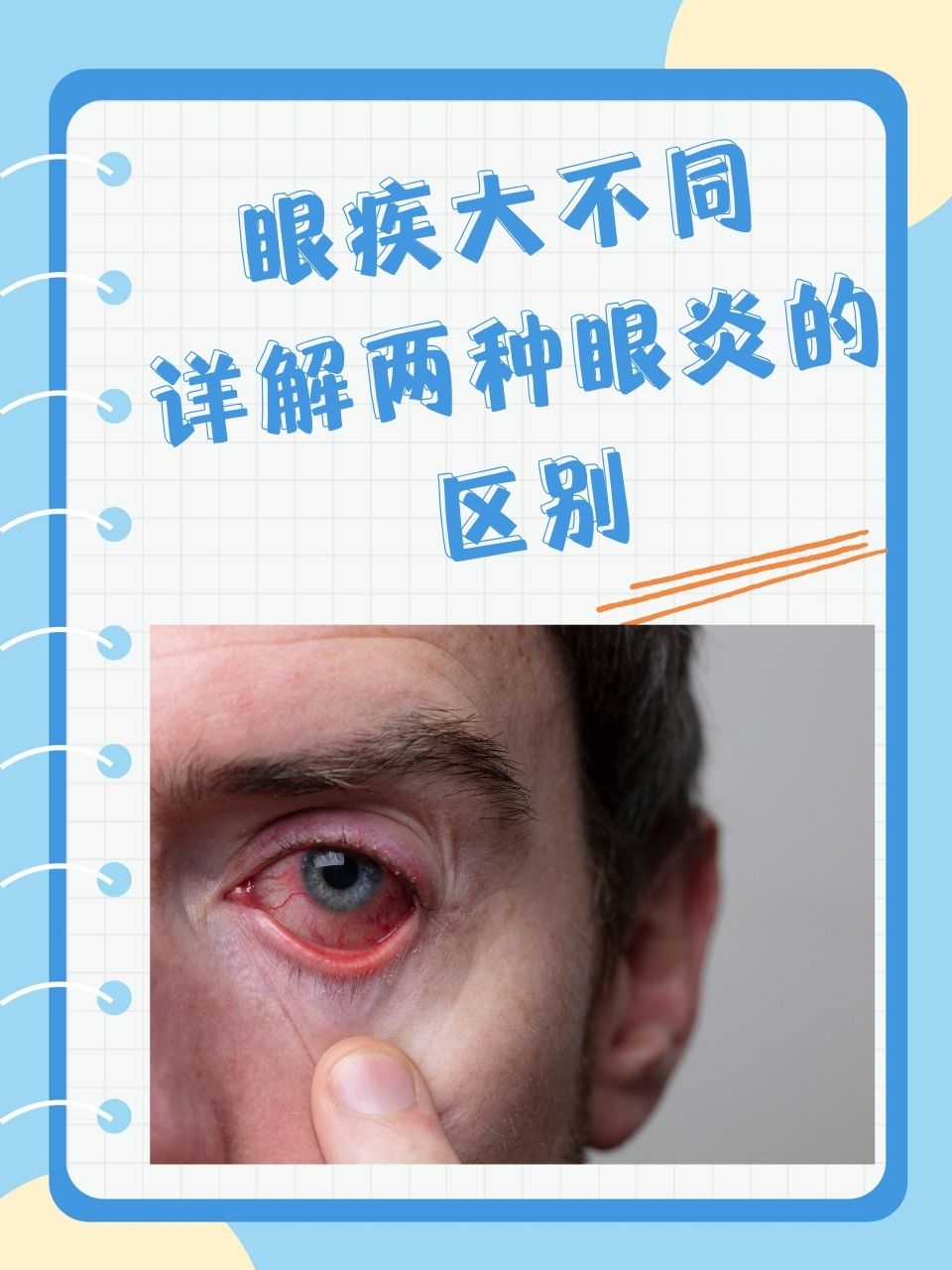 眼疾大不同:详解两种眼炎的区别 虹膜睫状体炎和葡萄膜炎常常让患者