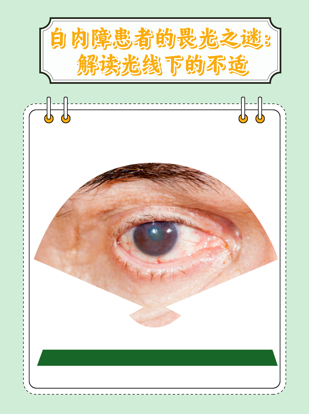 "白内障患者的畏光之谜:解读光线下的不适 白内障是一种常见的眼睛