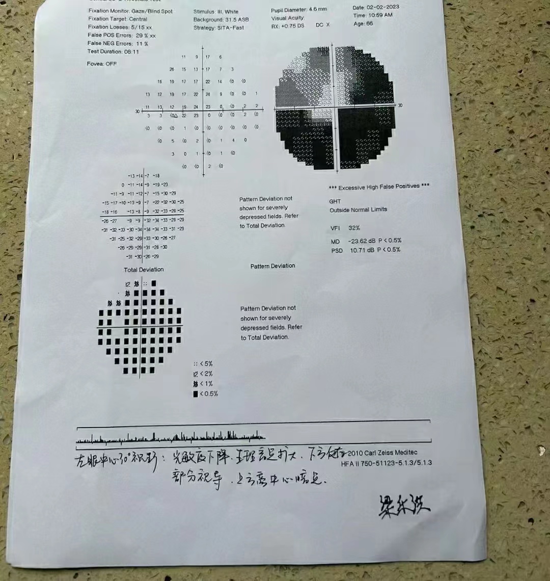 萎缩报告青光眼诊断书视野报告图怎么看视神经炎患者的视野检查结果?