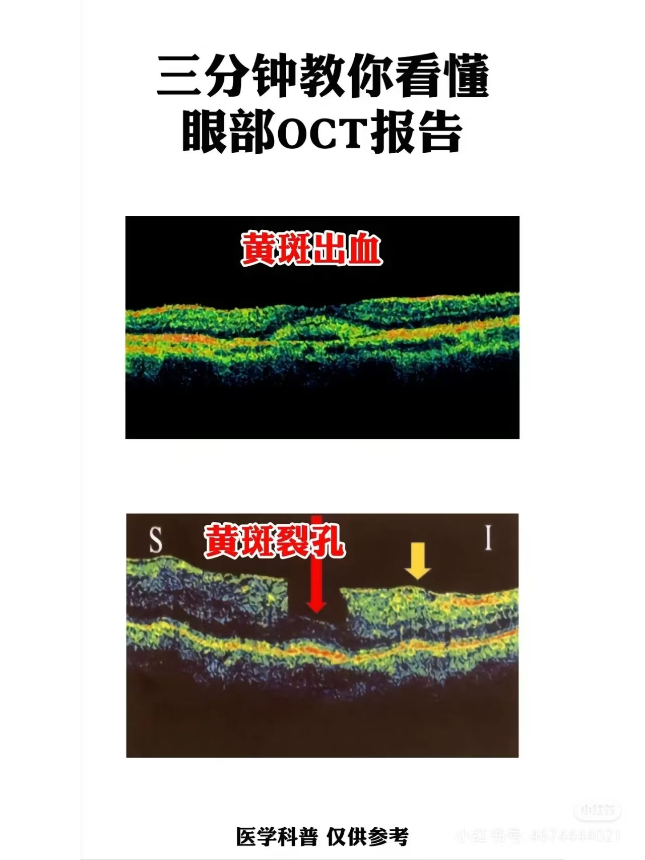 oct是什么? oct全称是光学相干断层扫描