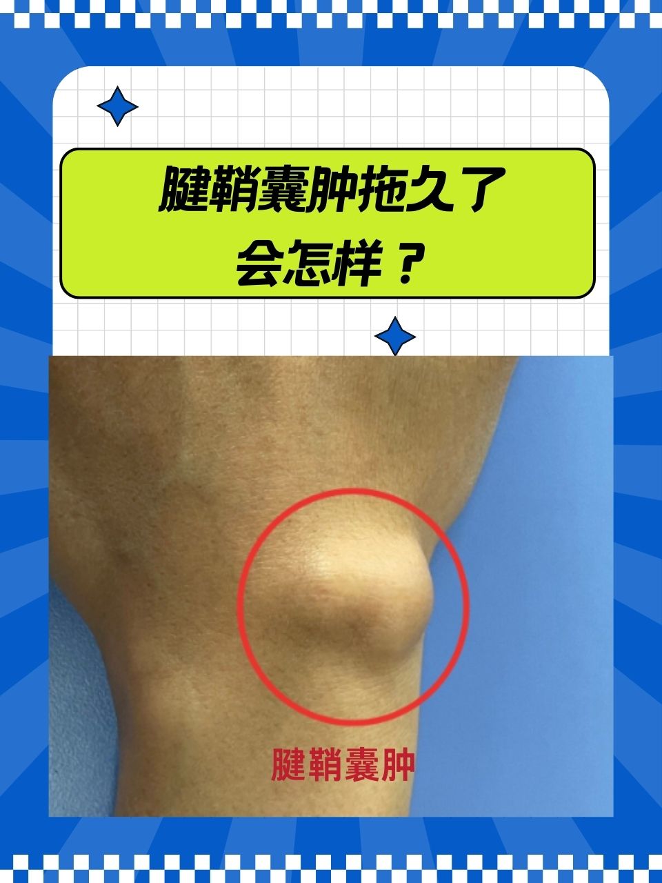 腱鞘囊肿拖久了会怎样 腱鞘囊肿初期可能只是一个小小的凸起,不痛不痒