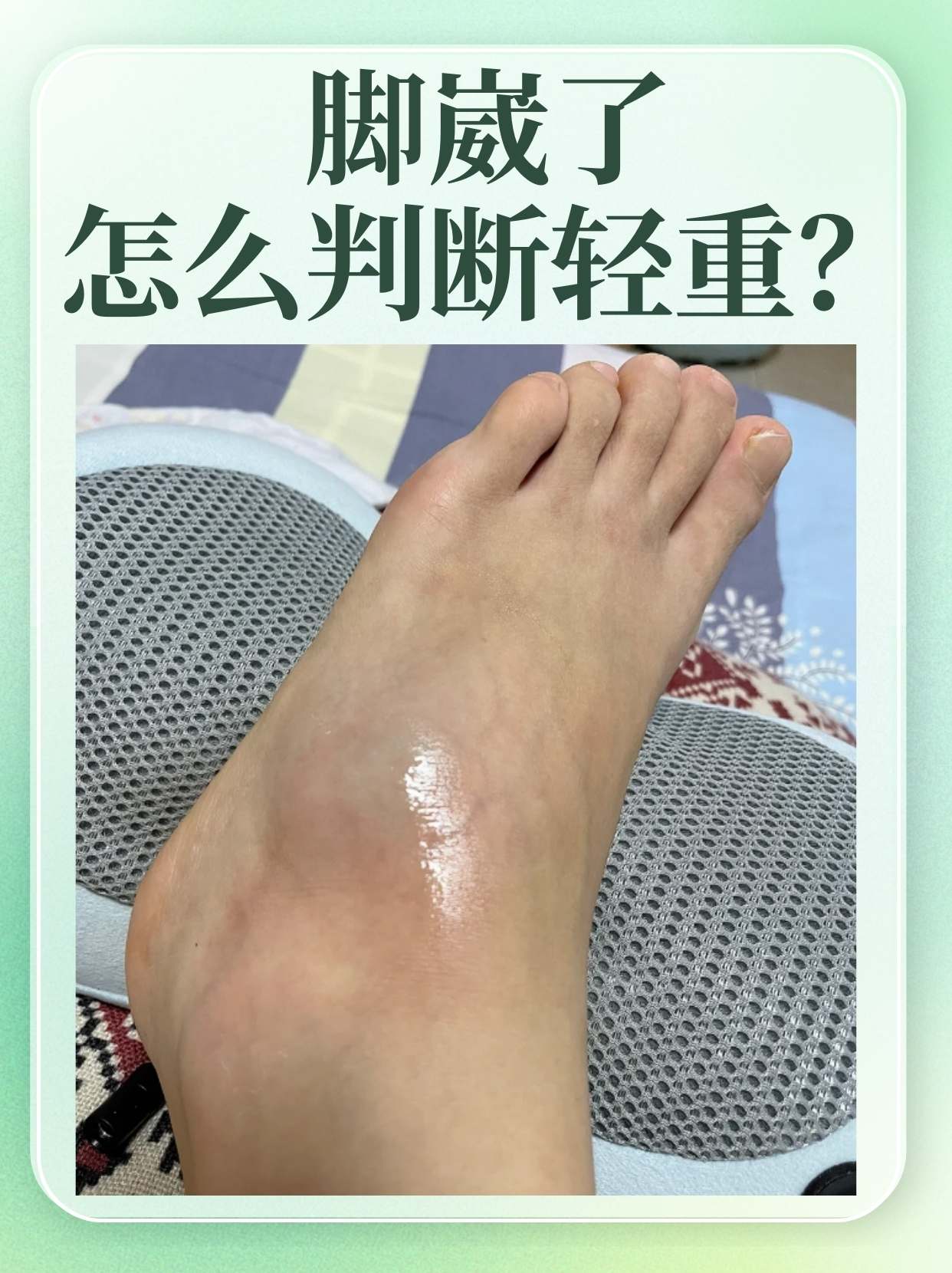 脚踝扭伤图片脚扭伤图片脚崴了脚踝肿了怎么办脚崴实拍脚扭伤红肿图片