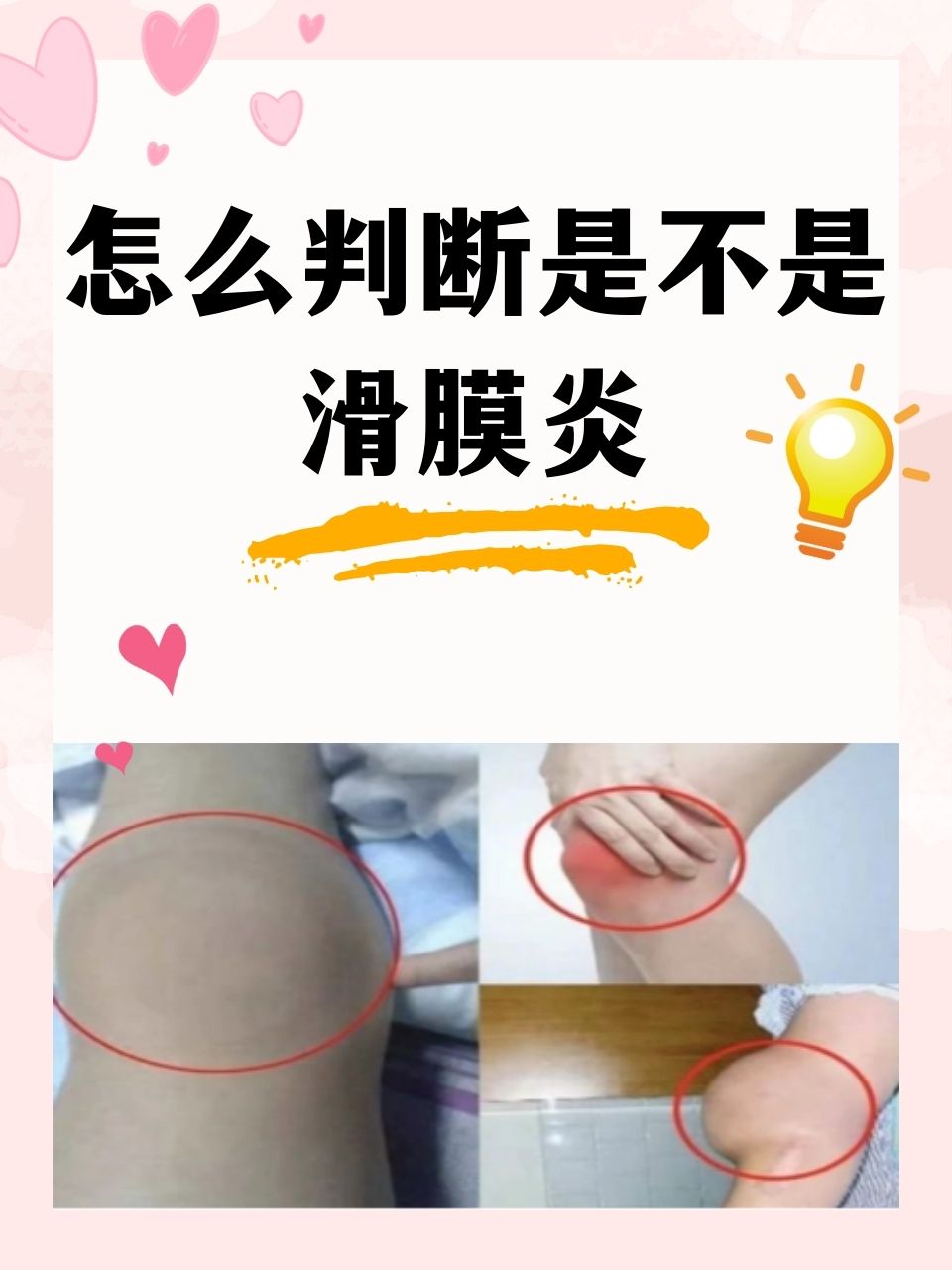 滑膜炎是一种较为常见的关节疾病,它可能影响各个年龄段的人群.