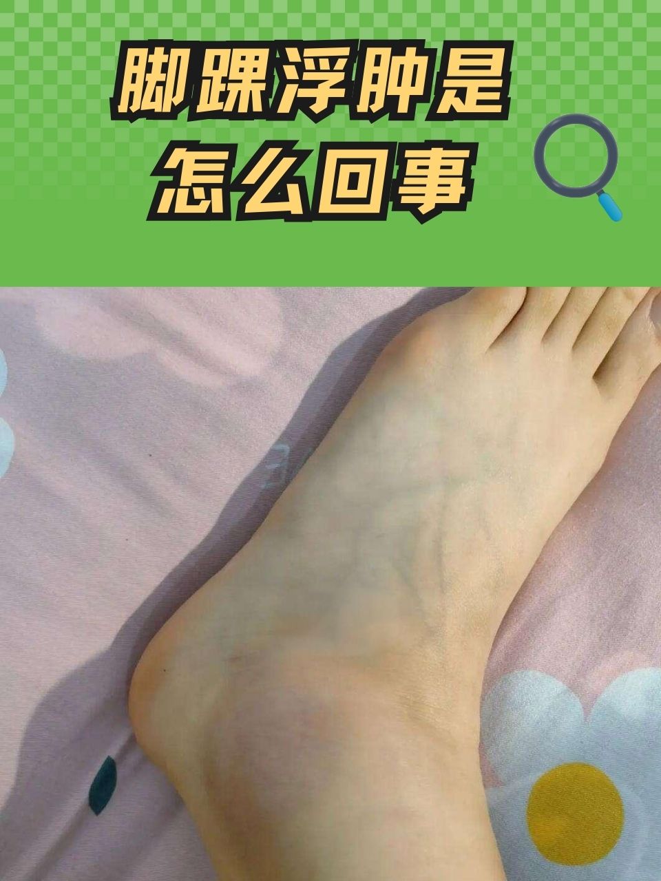 脚踝肿的照片真实图片