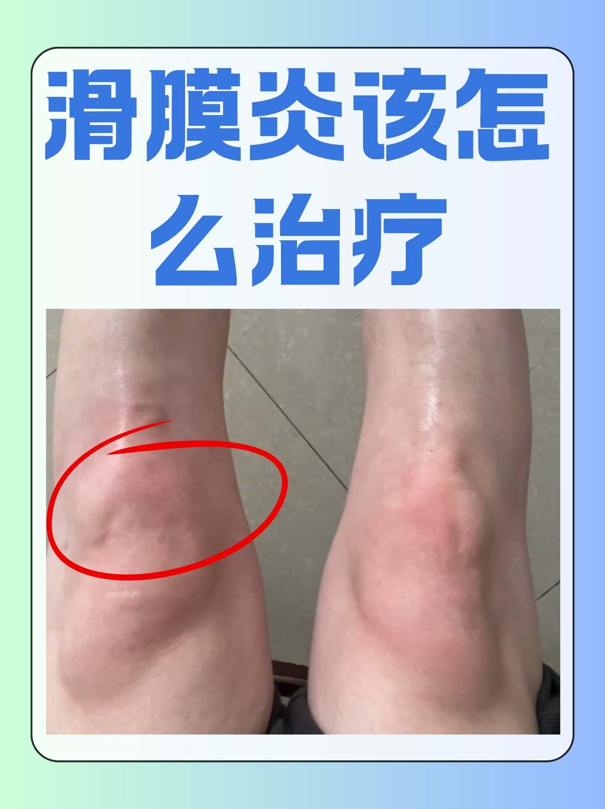 滑膜炎该怎么治疗  滑膜炎作为关节内的一种常见无菌性炎症,主要由
