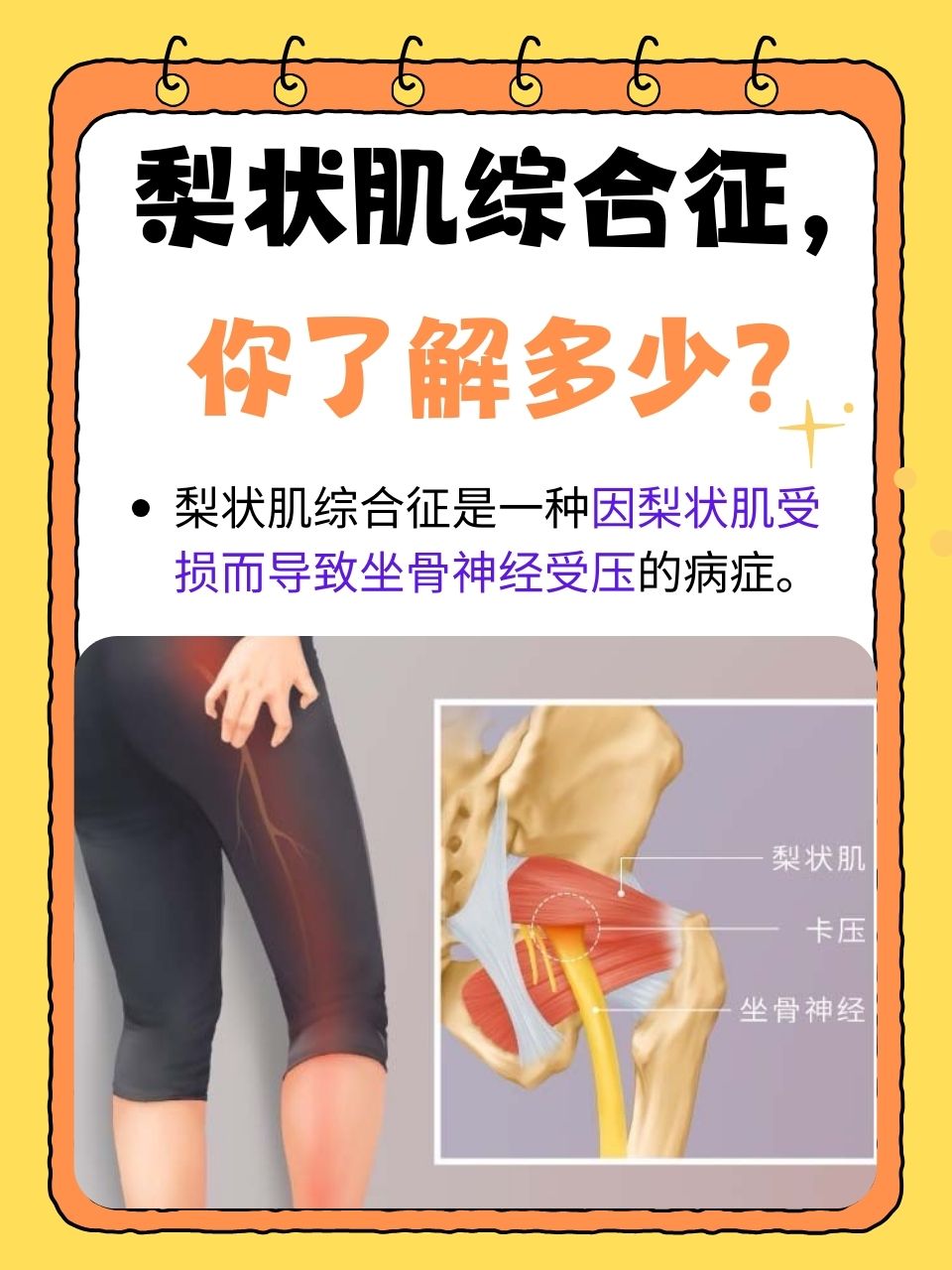 其中一种名为"梨状肌综合征"的病症,逐渐引起了人们的关注