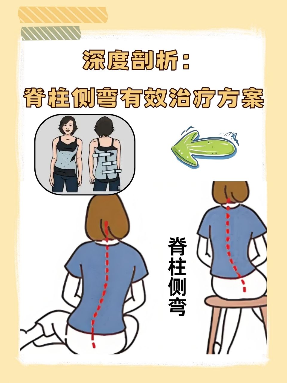 脊柱侧弯一般寿命多长为什么在线