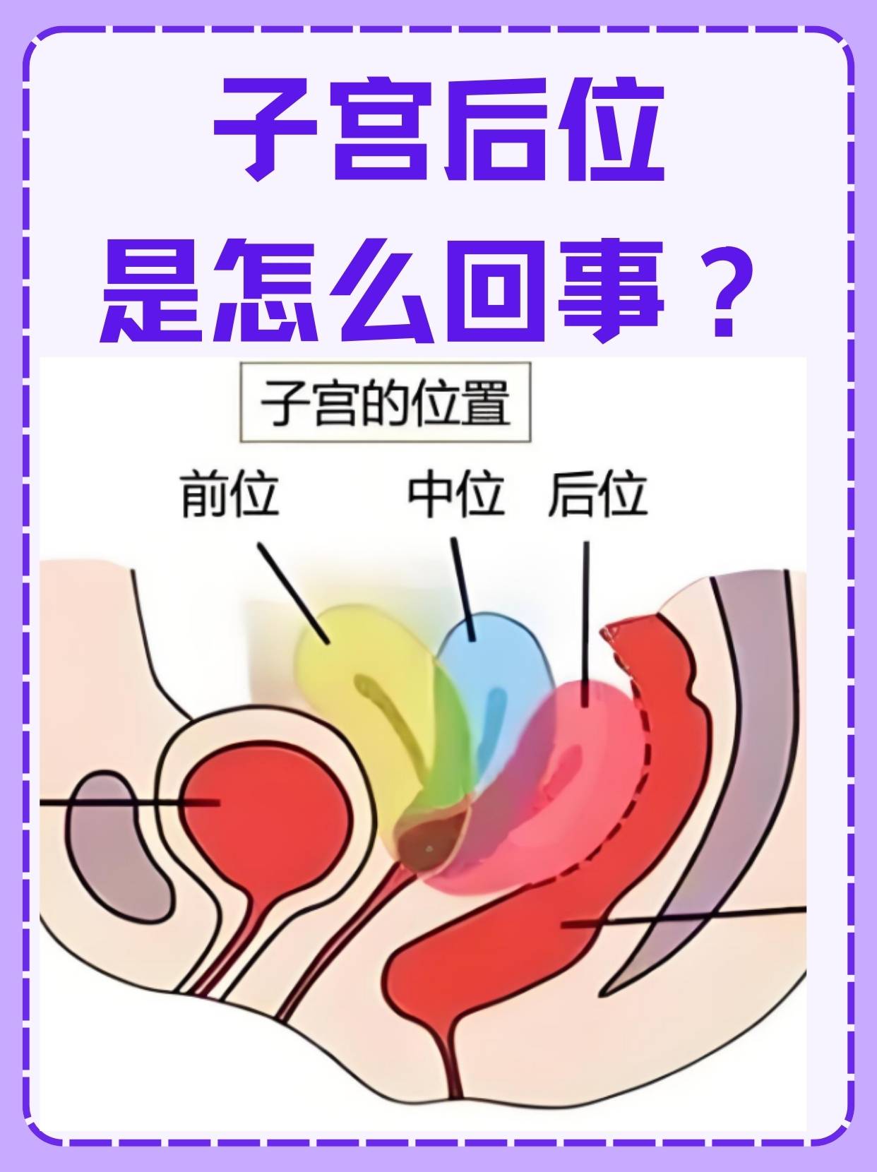 然而,有些女性在进行妇科检查时,会听到"子宫后位"这个词,心中不禁