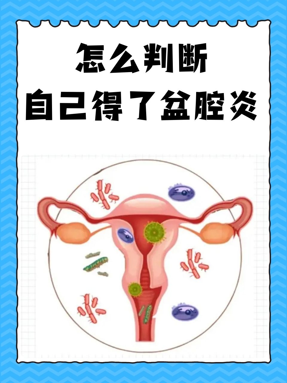 怎么判断自己得了盆腔炎