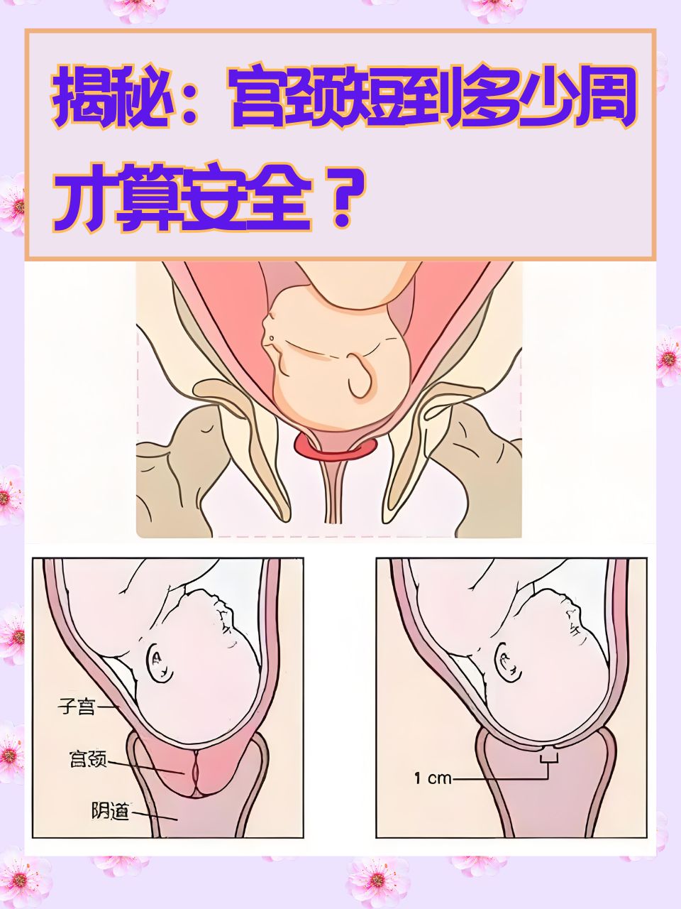 在孕育生命的过程中,宫颈长度是一个备受关注的重要指标