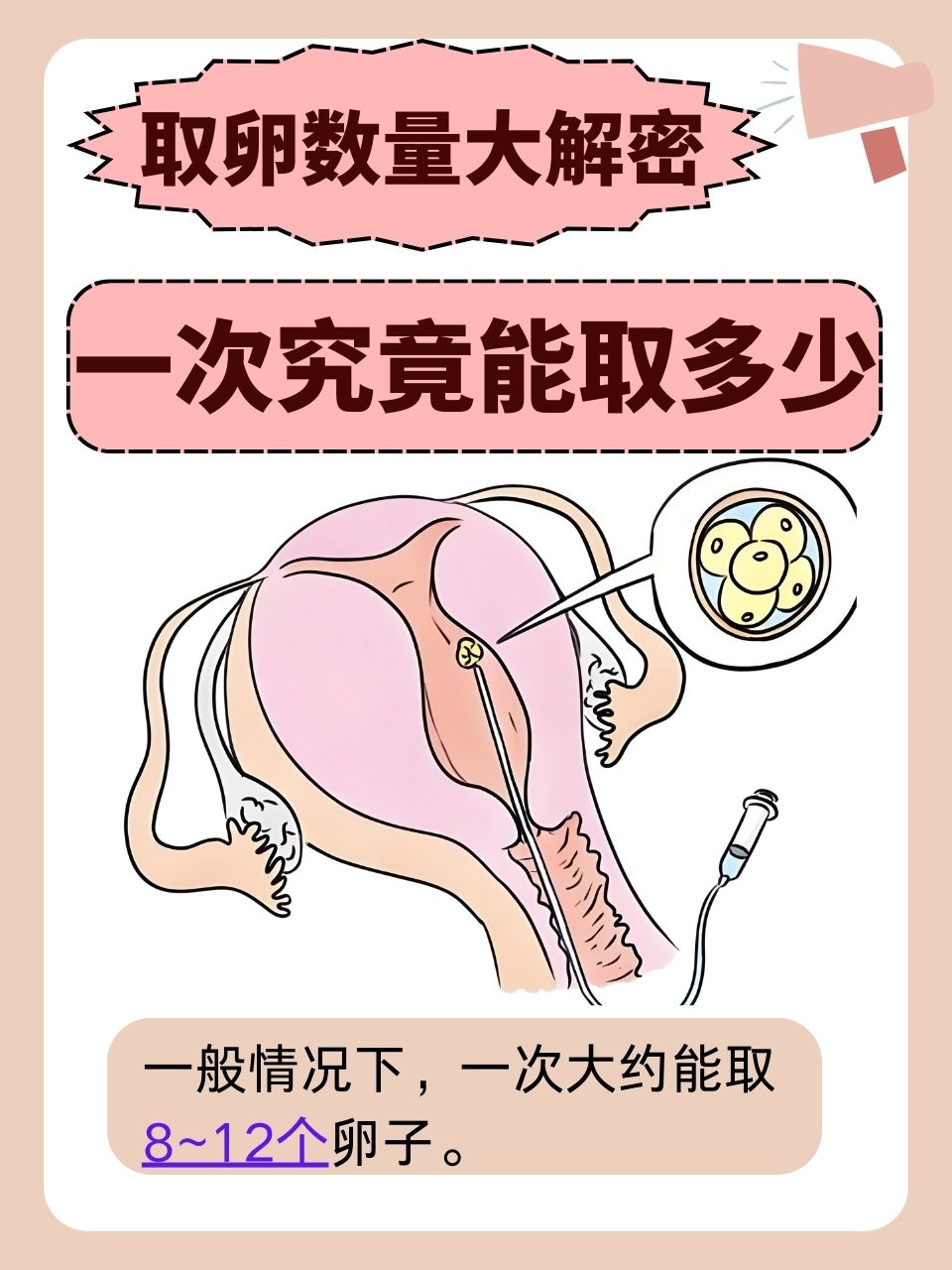 试管婴儿男方怎么取卵