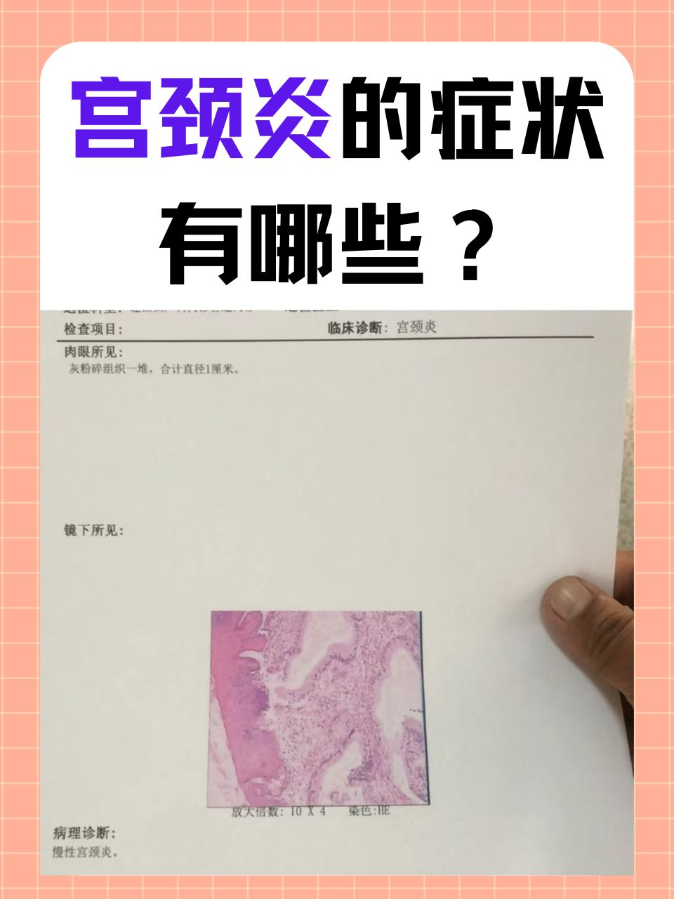 在女性的生殖健康中,宫颈炎是一种较为常见的疾病