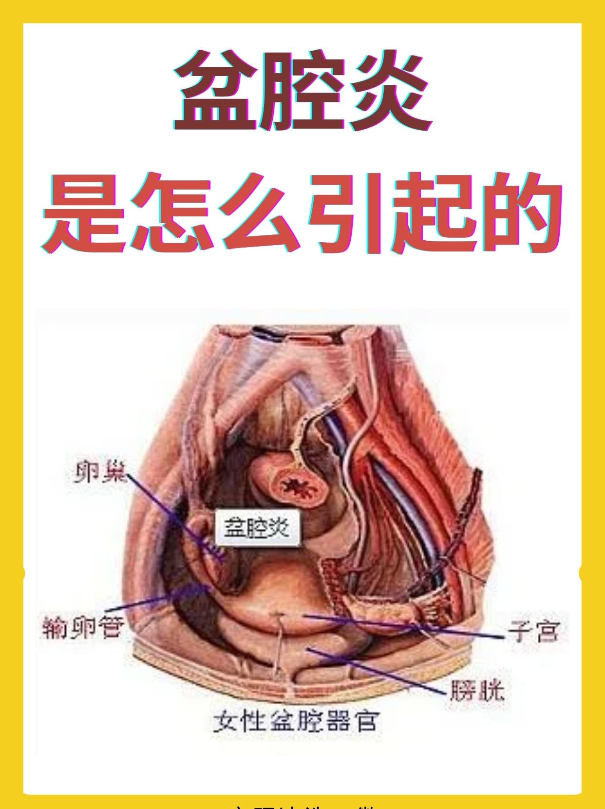 许多女性都遭受着盆腔炎带来的困扰,那么盆腔炎到底是怎么引起的呢?