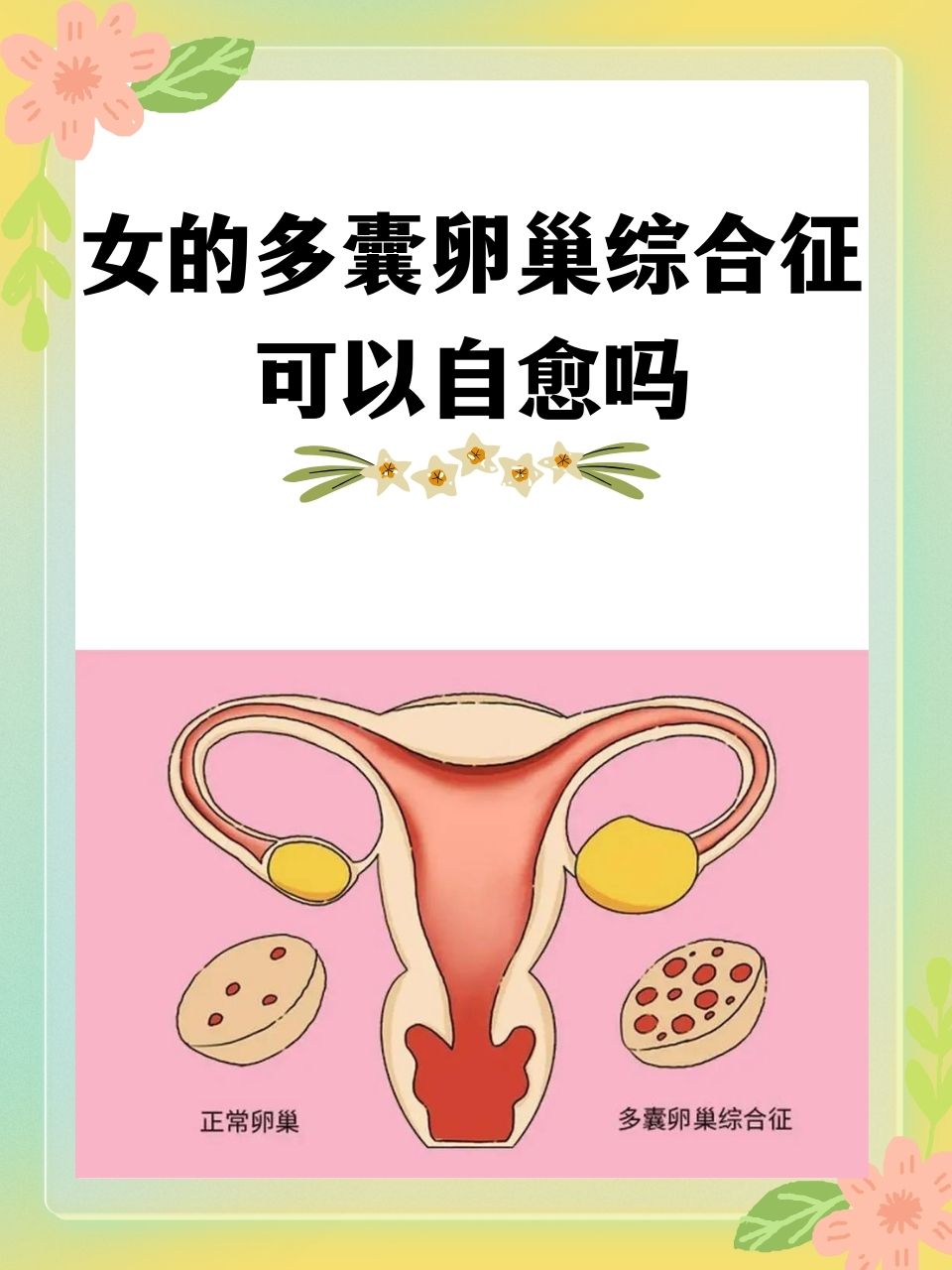 多囊会自愈怀孕吗(多囊可能会自然怀孕吗)  第2张