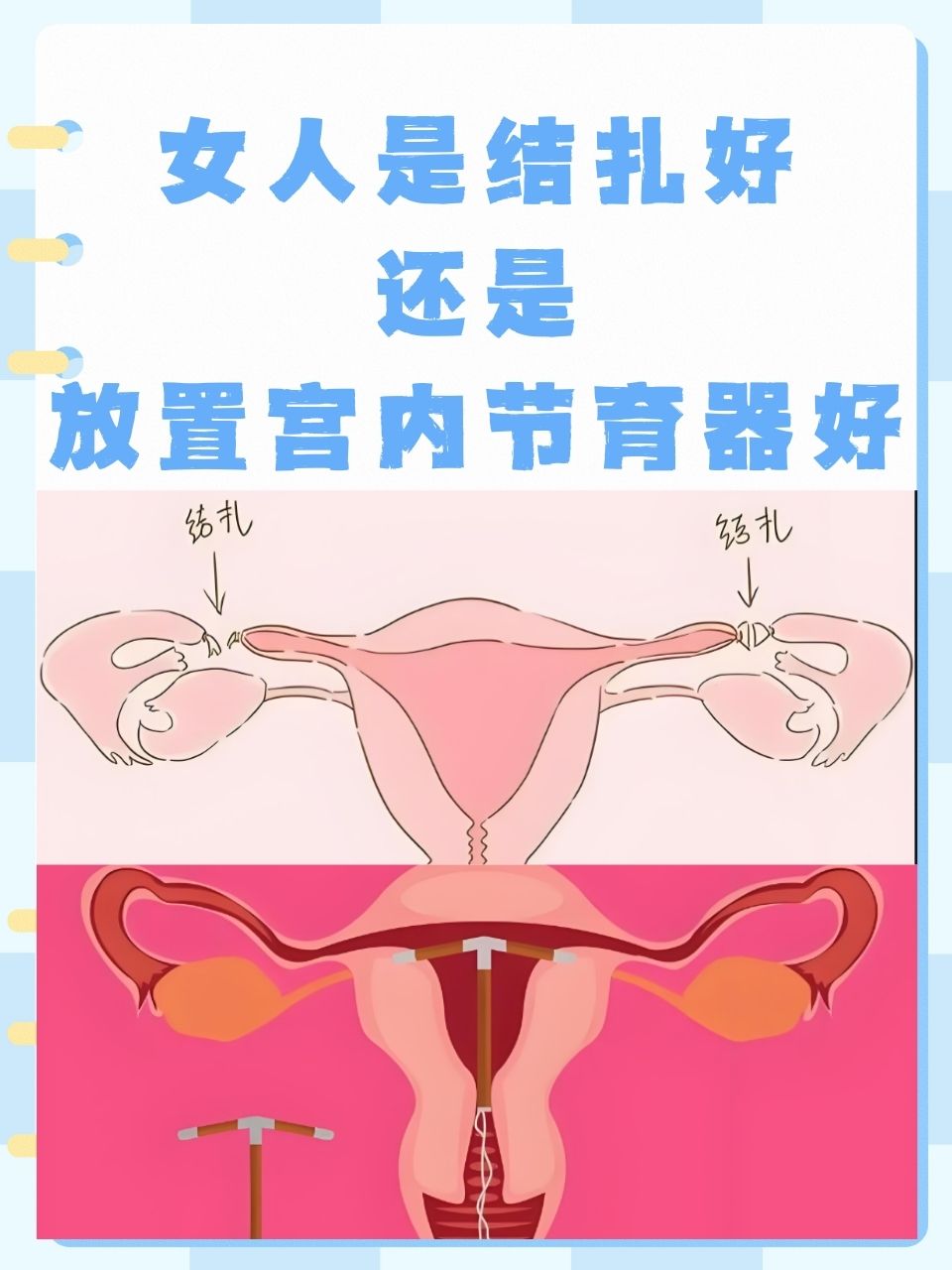 看女人结扎 地方图片