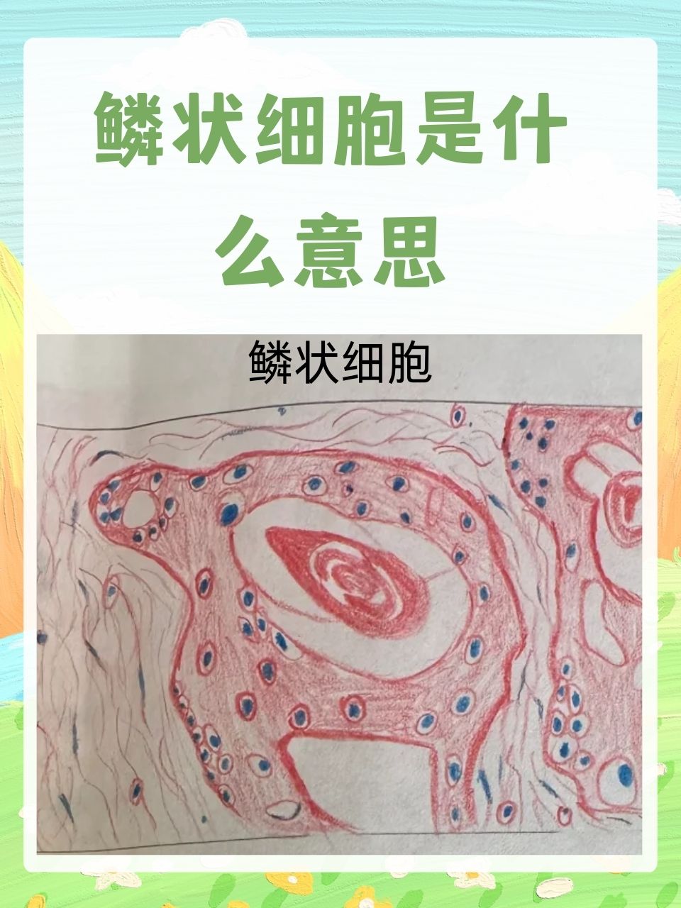 鳞状细胞,也被称为鳞状上皮细胞,是上皮细胞组织的一种,这些细胞