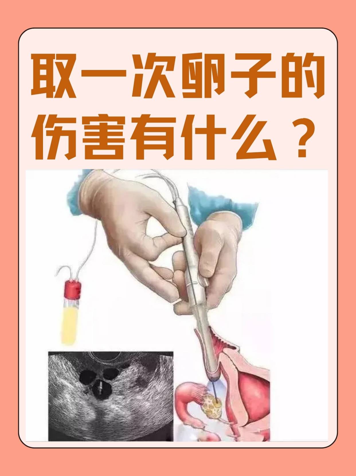 试管婴儿取卵针图片图片