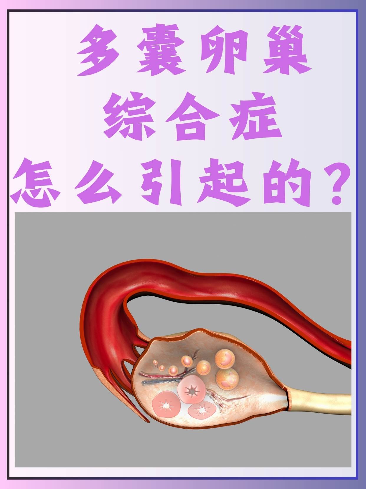 卵巢多囊的原因及治疗_卵巢多囊是怎么形成的,需要怎么治疗