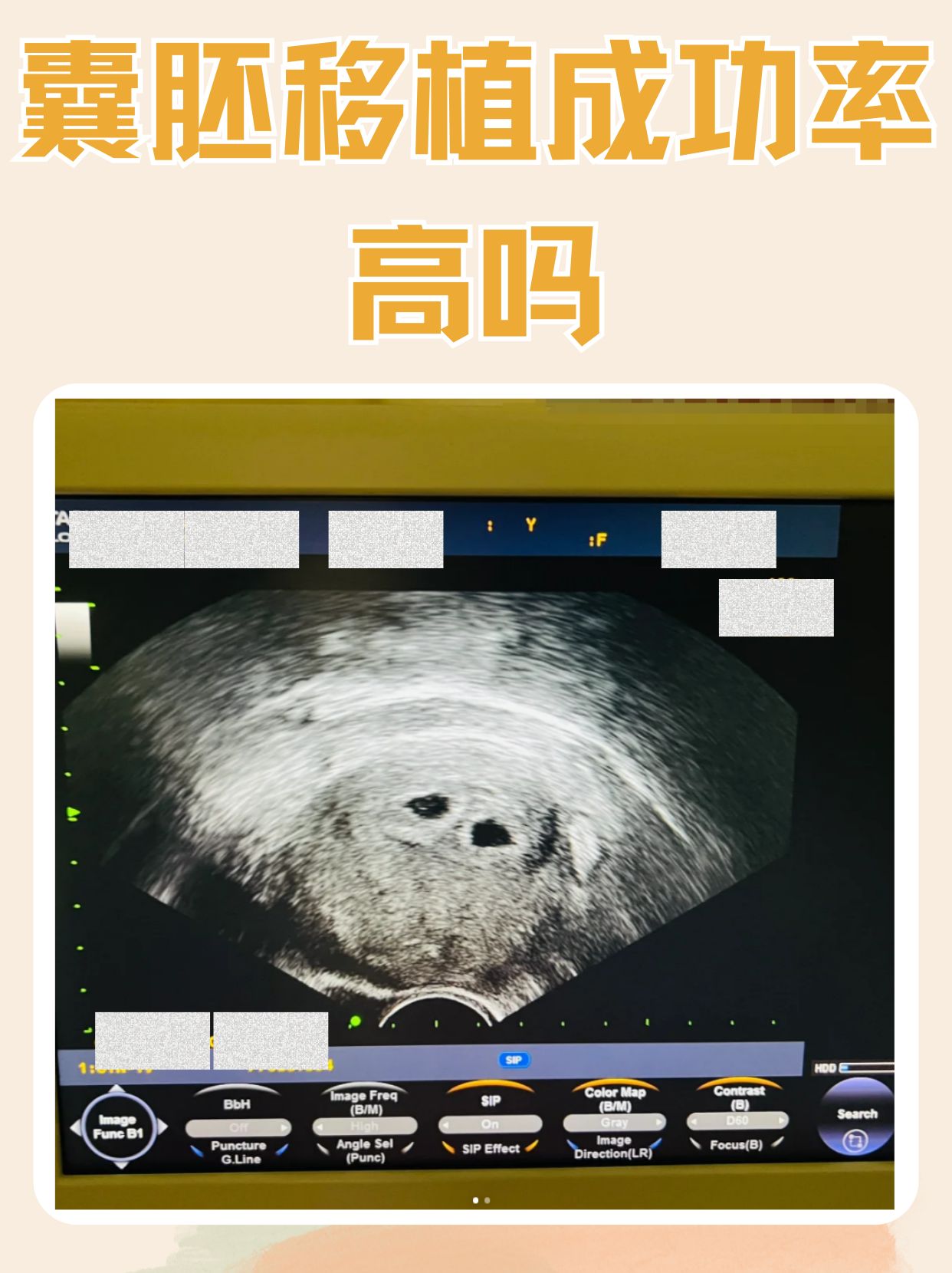 囊胚移植不成功最明显的感觉_囊胚移植失败是什么原因引起的