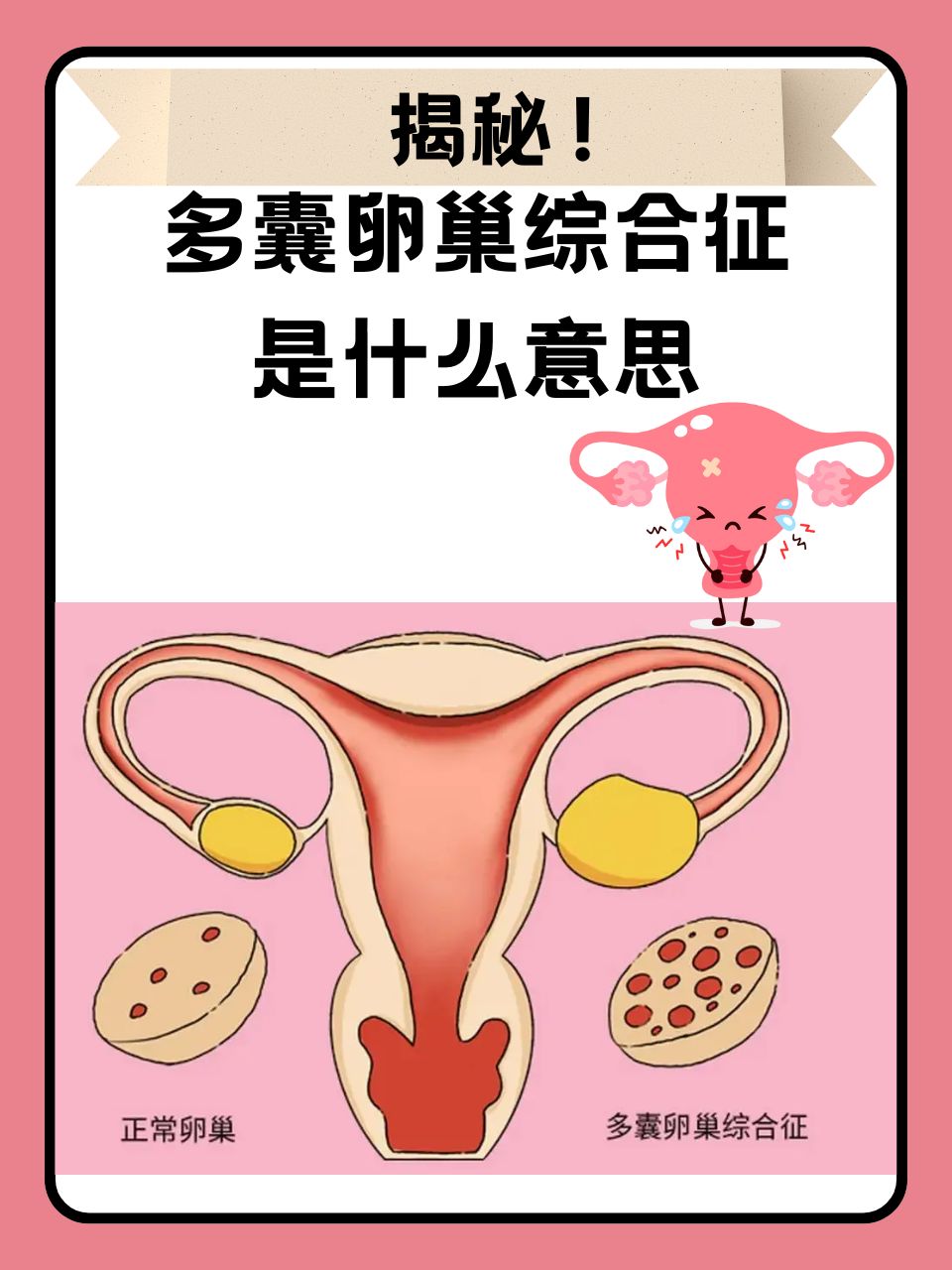 多囊卵巢有什么症状_多囊卵巢会有什么危害呢