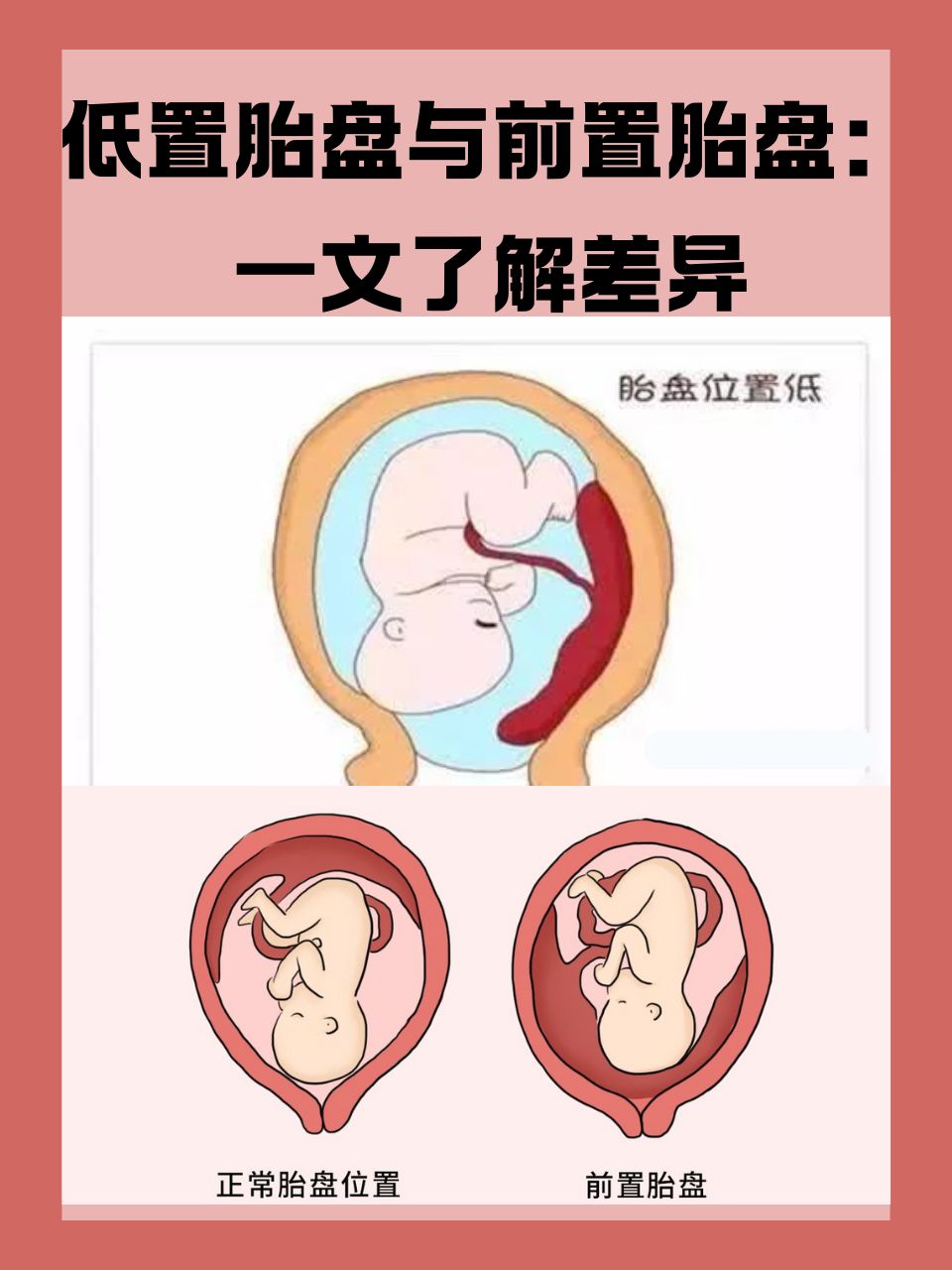 低置胎盘与前置胎盘:一文了解差异