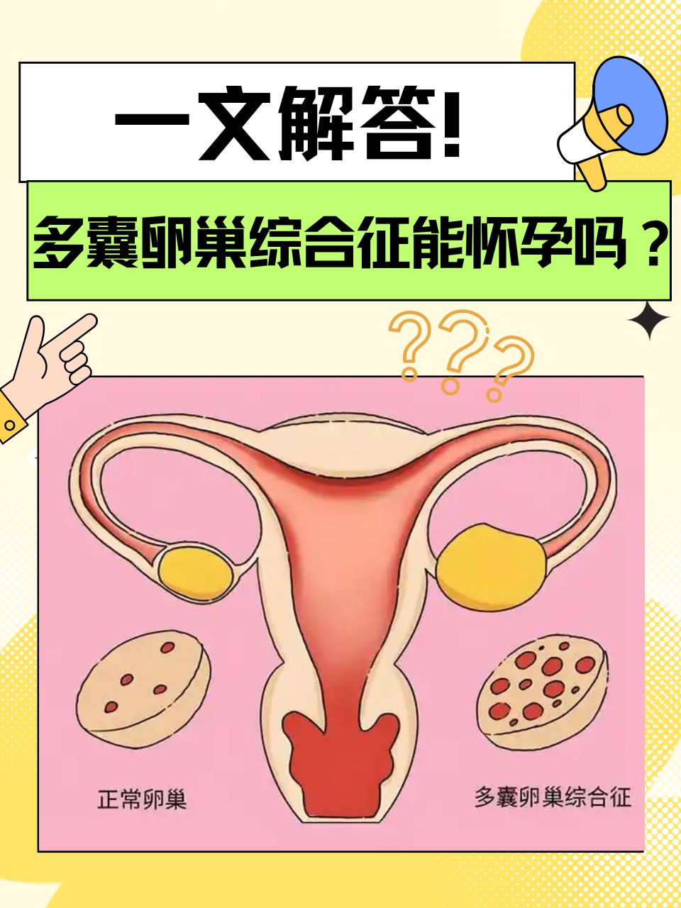 关于卵巢多囊(关于卵巢多囊样改变以下错误的是)