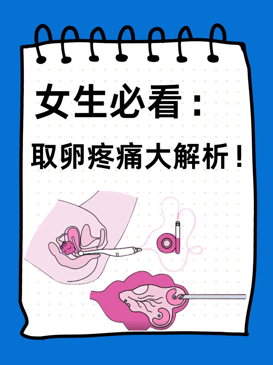 取卵方式_取卵怎样取  第2张