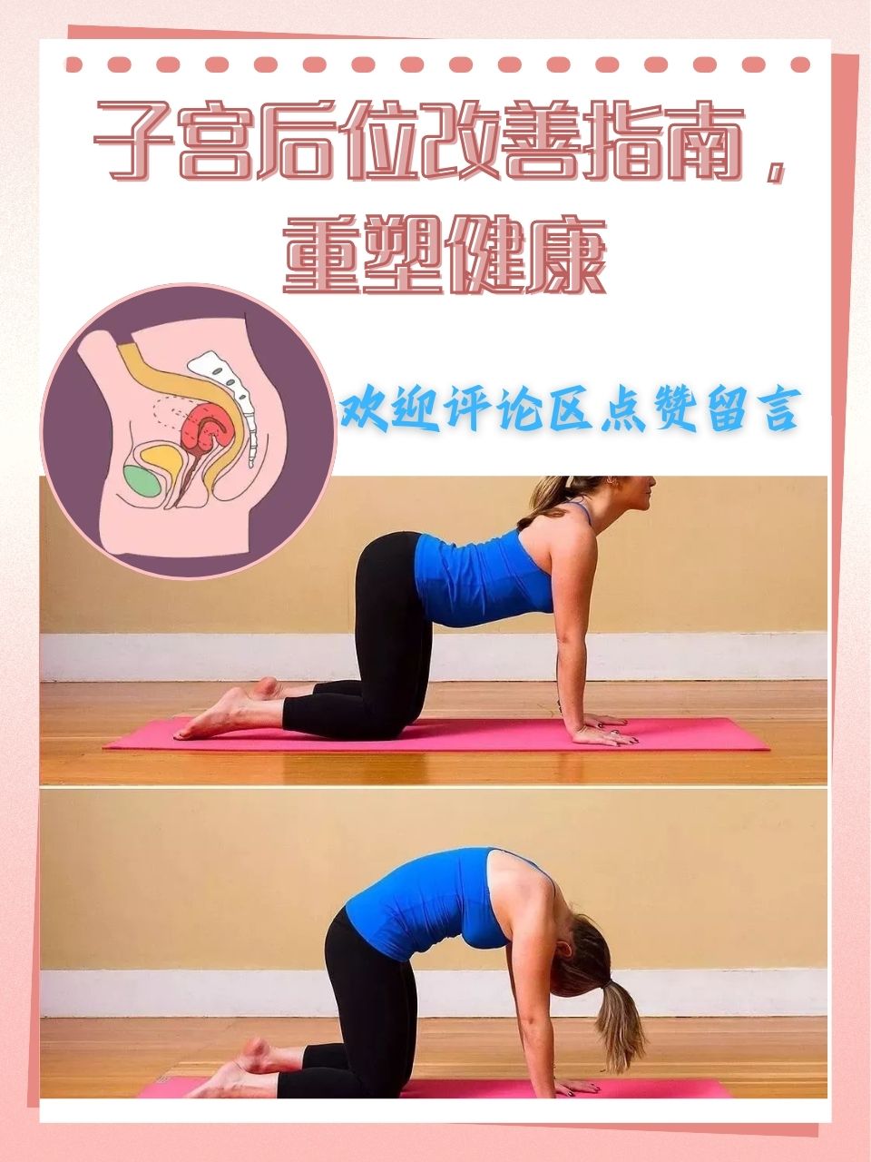 子宫后位改善指南,重塑健康