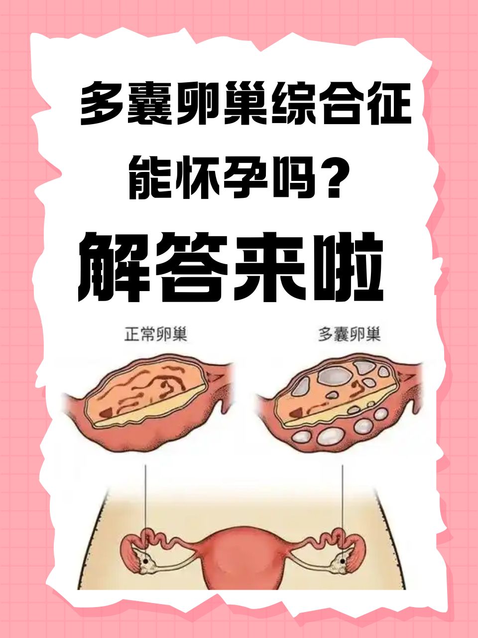 多囊性卵巢综合症怎么引起_多囊卵巢综合症由什么原因引起  第2张
