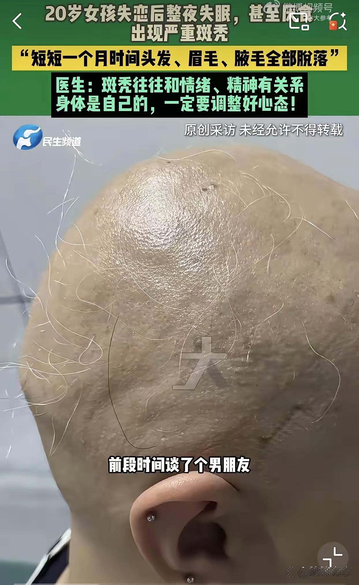拿着严重斑秃诊断书坐在郑大一附院皮肤科