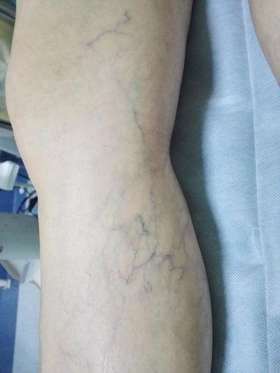 得了静脉曲张不想做手术?还有这2个办法!