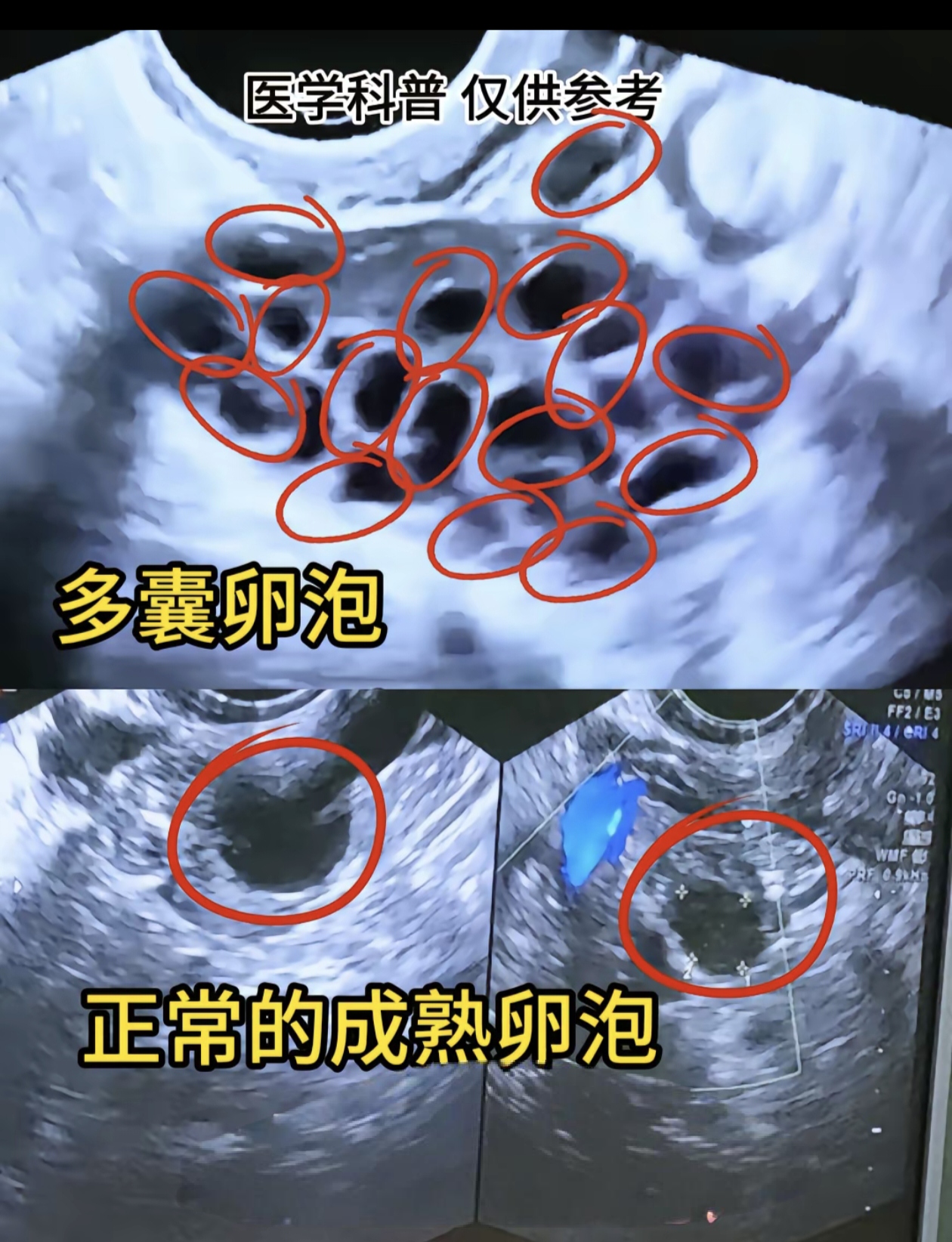 不孕卵巢多囊表现(不孕卵巢多囊表现是什么)  第2张