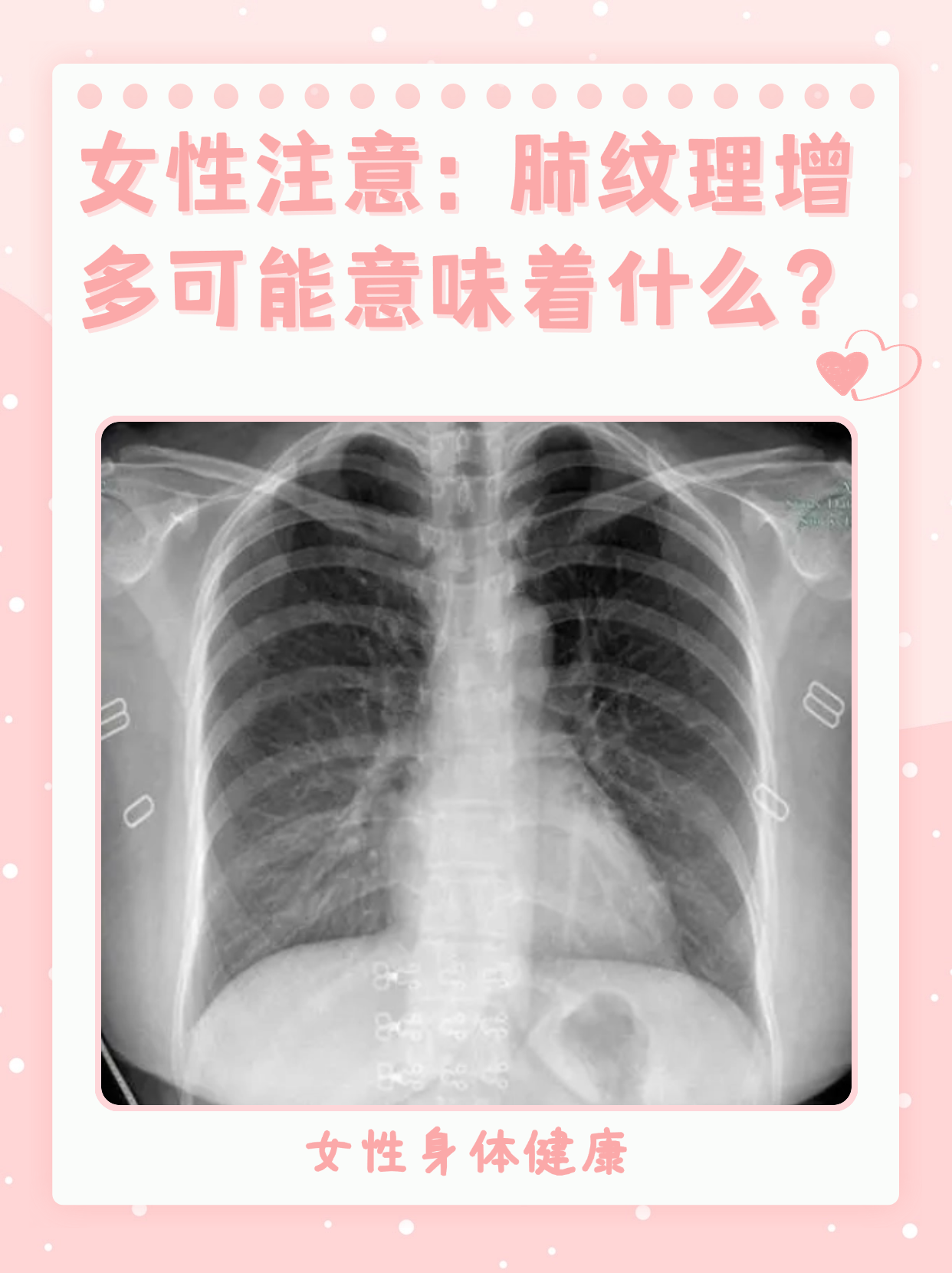 很多女性在进行胸部 x 光或 ct 检查后,会被告知存在肺纹理增多的