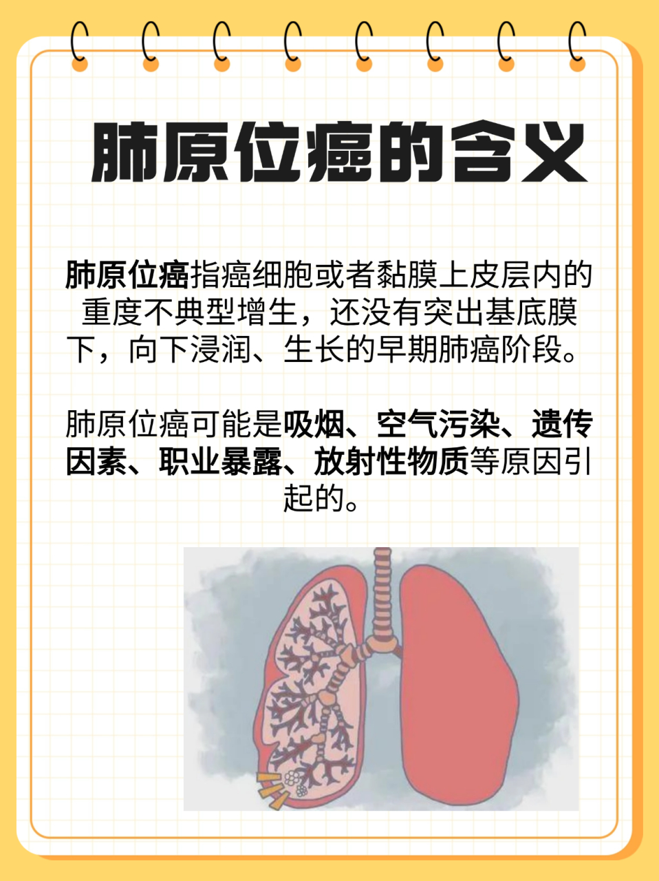 肺原位癌,作为肺癌的早期阶段,是指癌细胞局限于黏膜上皮层内的重度