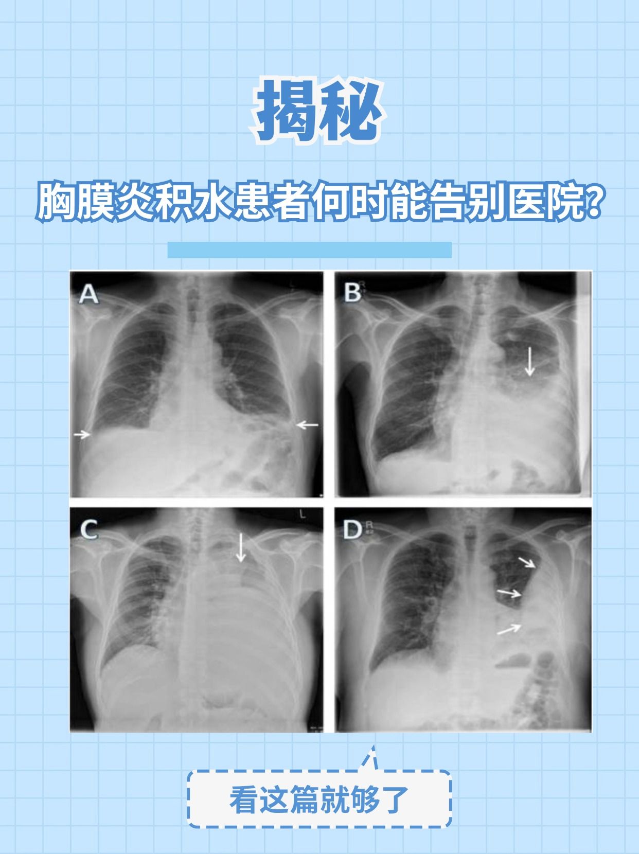 胸膜增厚图片