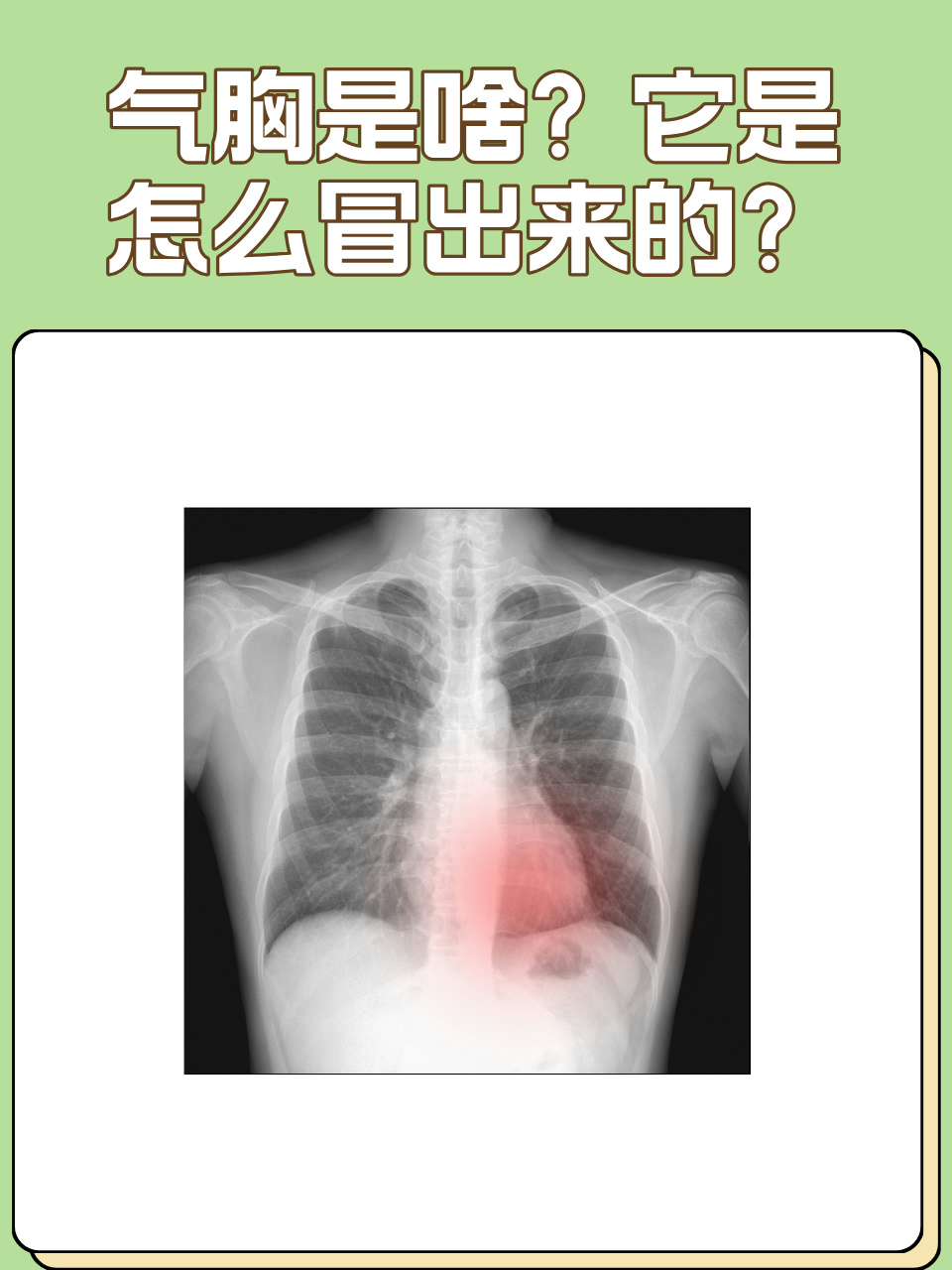 气胸分级图片