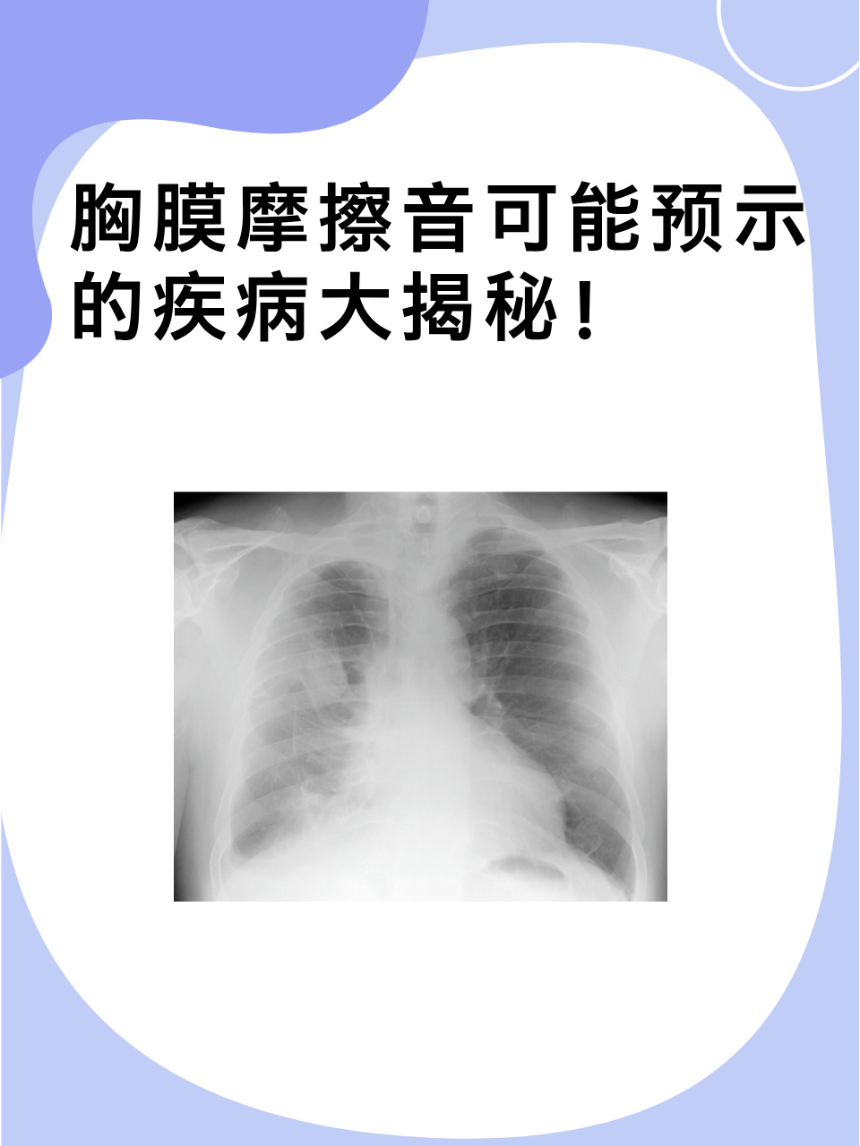 听到"胸膜摩擦音"这个词是不是觉得很陌生又有点小紧张呢?