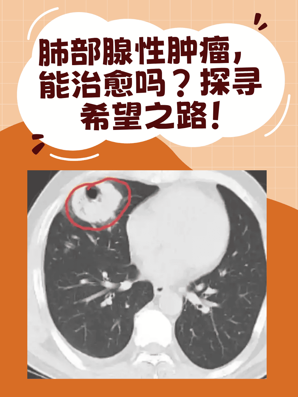 探寻希望之路! 今天我们来聊聊让人忧心的肺部腺性肿瘤