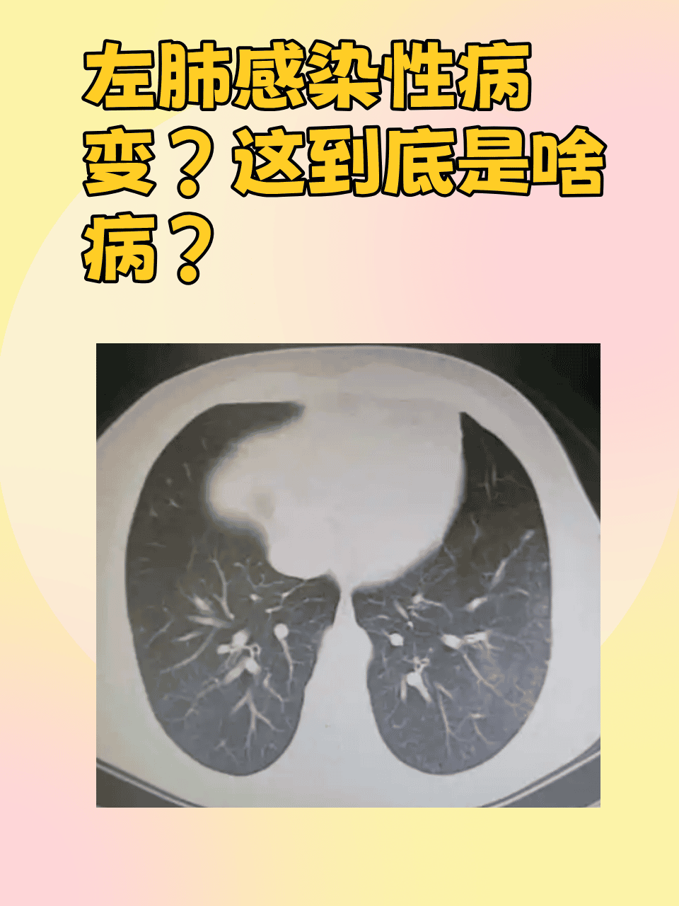 左肺感染性病变是指左侧肺部受到各种病原体的感染,引起的一系列怖眄