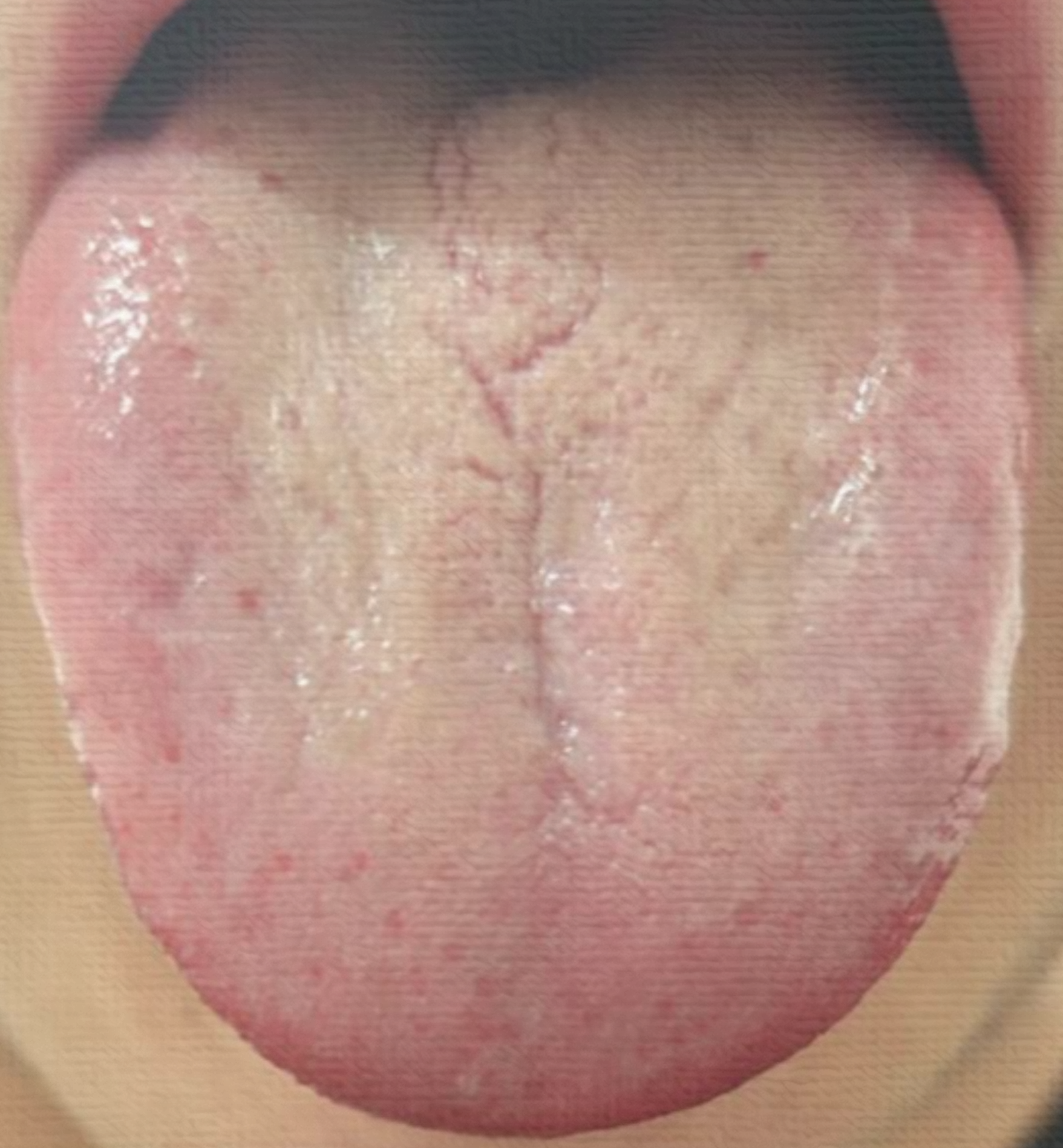 如果你发现你的舌头中间有一道裂痕,一直裂到舌根,而且舌苔黄厚,很多