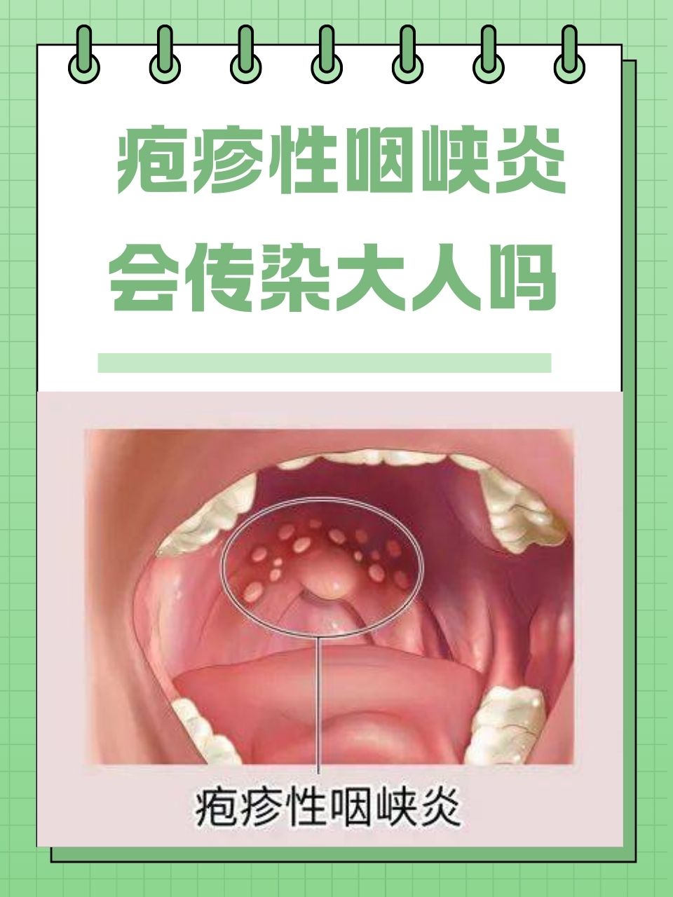 疱疹性咽峡炎会传染大人吗 在这个季节交替的时节,疱疹性咽峡炎作为一