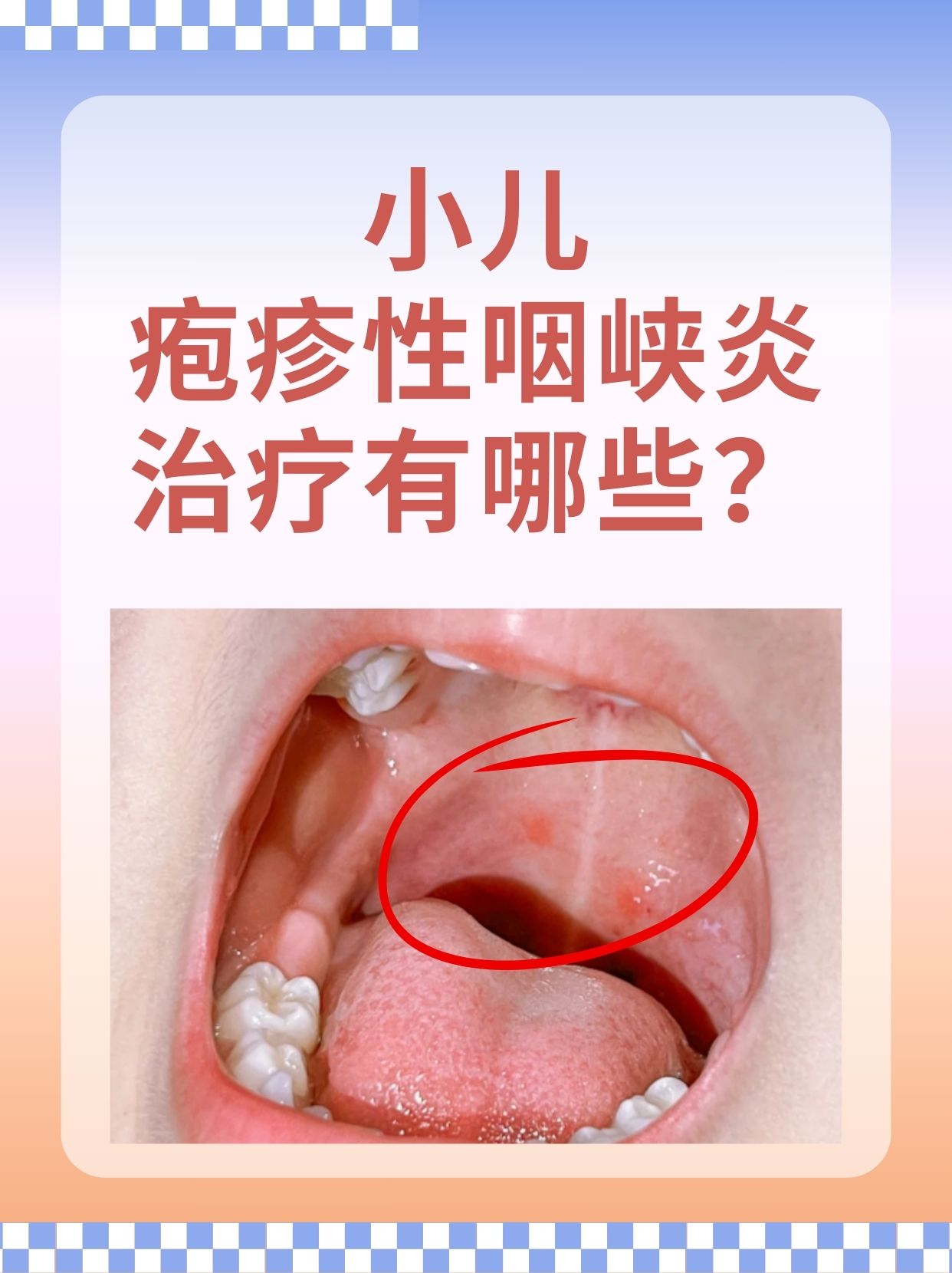 小儿疱疹性咽峡炎怎么治疗 小儿疱疹性咽峡炎是一种常见的儿童疾病