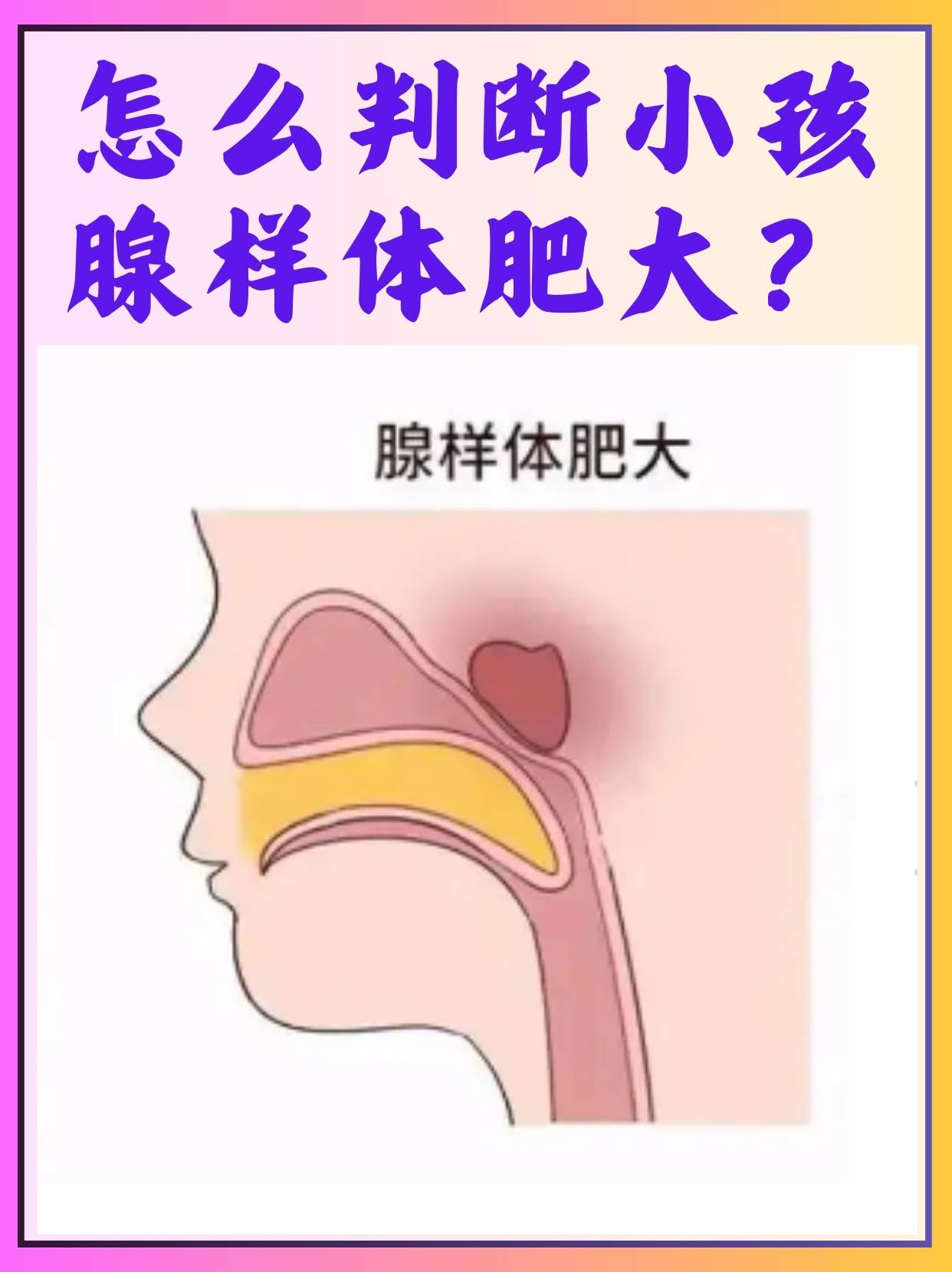 怎么判断小孩腺样体肥大 在孩子的成长过程中,家长们时常会关注孩子的
