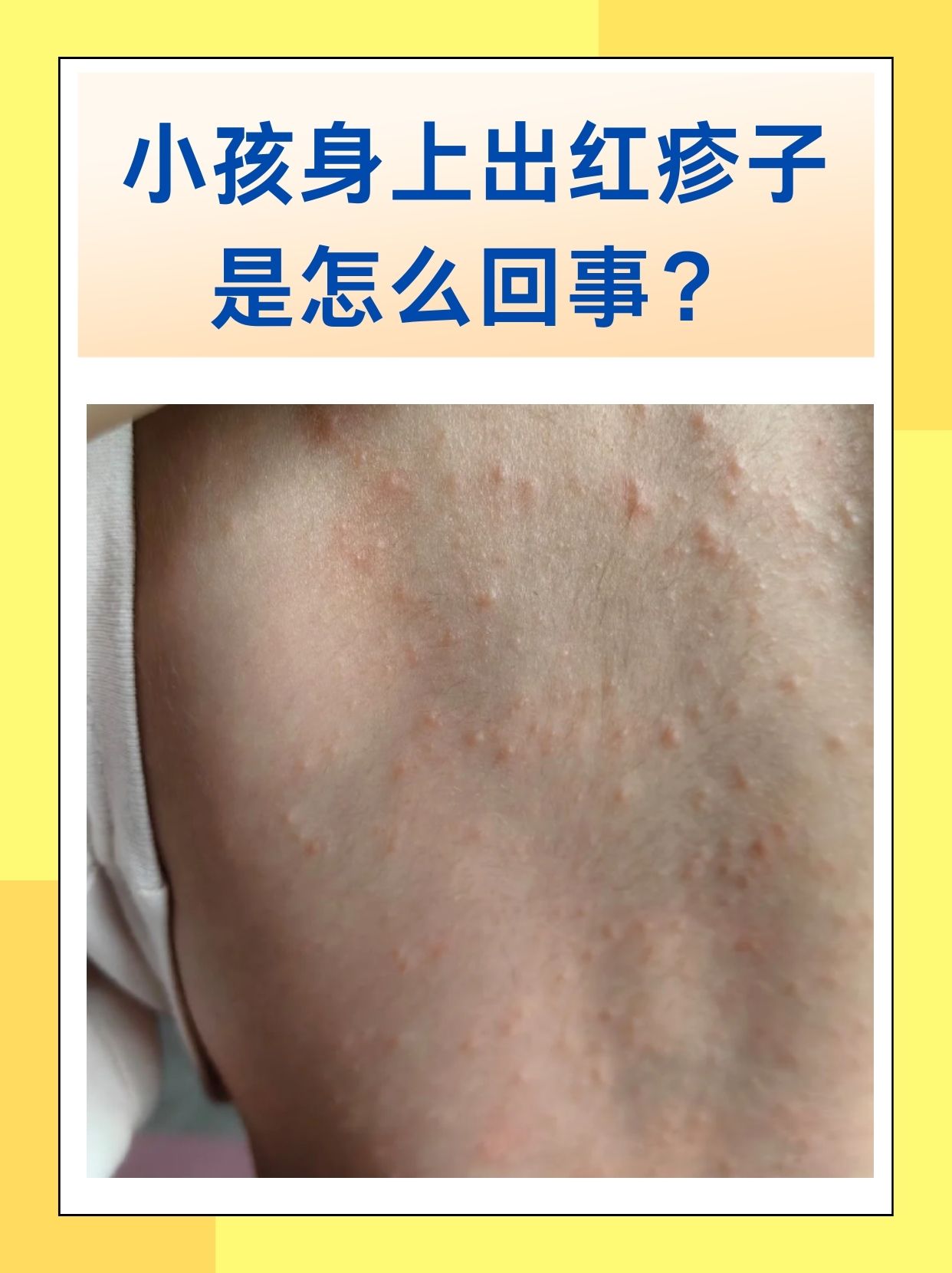 过敏多因接触过敏原,湿疹和环境,体质有关,痱子在炎热时易出现